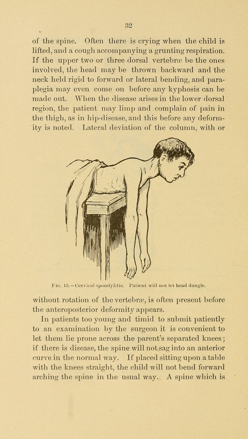 of the spine. Often there is crying when the child is lifted, and a cough accompanying a grunting respiration. If the upper two or three dorsal vertebrae be the ones involved, the head may be thrown backward and the neck held rigid to forward or lateral bending, and para- plegia may even come on before any kyphosis can be made out. When the disease arises in the lower dorsal region, the patient may limp and complain of pain in the thigh, as in hip-disease, and this before any deform- ity is noted. Lateral deviation of the column, with or Fig. 15.—Cervical spoudylitis. I'alieut will not let head dangle. without rotation of the vertebrae, is often present before the anteroposterior deformity appears. In patients too young and timid to submit patiently to an examination by the surgeon it is convenient to let them lie prone across the parent's separated knees; if there is disease, the spine will not sag into an anterior curve in the normal way. If placed sitting upon a table with the knees straight, the child will not bend forward arching the spine in the usual way. A spine which is