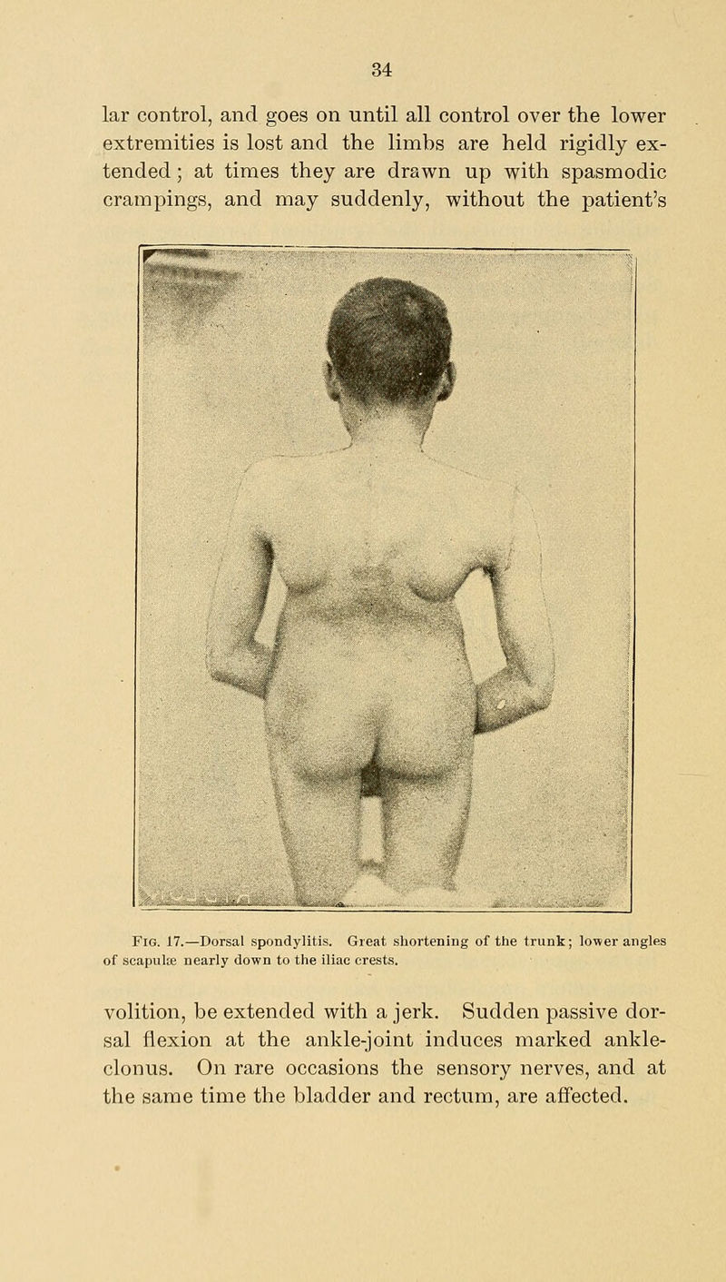 lar control, and goes on until all control over the lower extremities is lost and the limhs are held rigidly ex- tended ; at times they are drawn up with spasmodic crampings, and may suddenly, without the patient's Fig. 17.—Dorsal spondylitis. Great shortening of the trunk; lower angles of scapulte nearly down to the iliac crests. volition, be extended with a jerk. Sudden passive dor- sal flexion at the ankle-joint induces marked ankle- clonus. On rare occasions the sensory nerves, and at the same time the bladder and rectum, are affected.