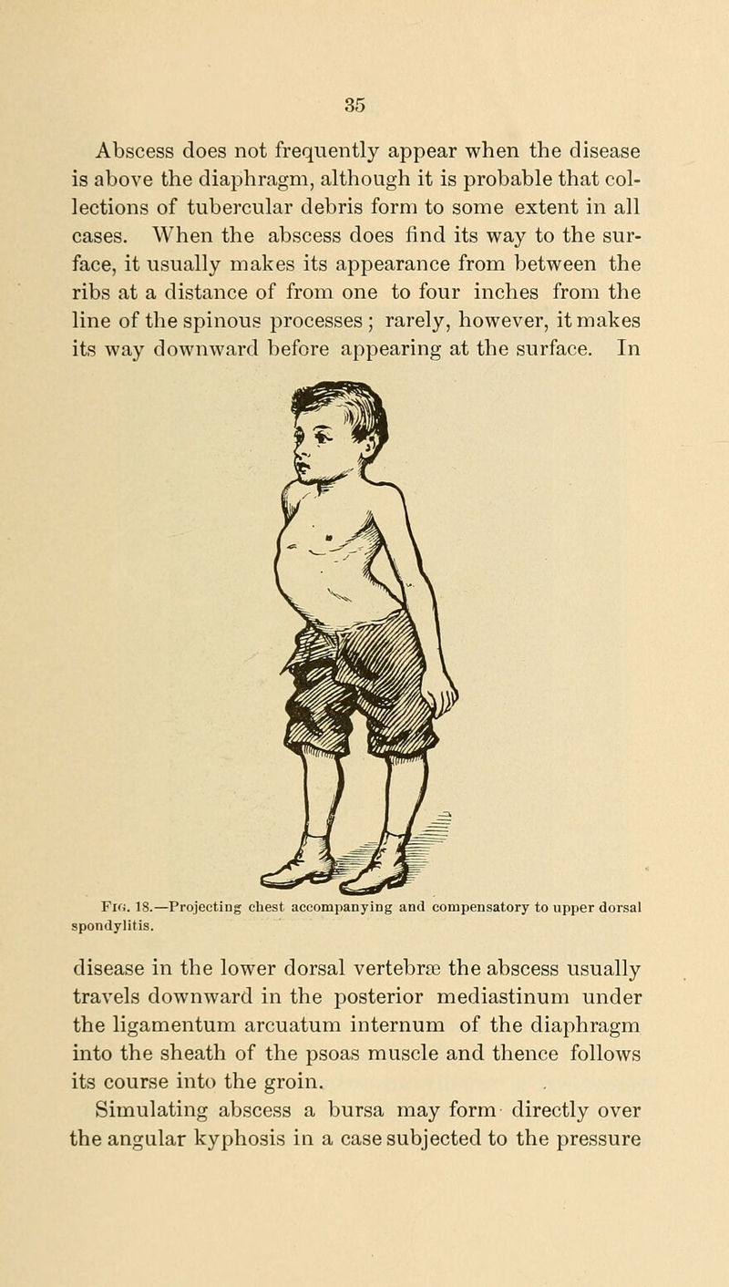 Abscess does not frequently appear when the disease is above the diaphragm, although it is probable that col- lections of tubercular debris form to some extent in all cases. When the abscess does find its way to the sur- face, it usually makes its appearance from between the ribs at a distance of from one to four inches from the line of the spinous processes ; rarely, however, it makes its way downward before appearing at the surface. In Fio. 18.—Projecting chest, accompanying and compensatory to upper dorsal spondylitis. disease in the lower dorsal vertebrse the abscess usually travels downward in the posterior mediastinum under the ligamentum arcuatum internum of the diaphragm into the sheath of the psoas muscle and thence follows its course into the groin. Simulating abscess a bursa may form directly over the angular kyphosis in a case subjected to the pressure