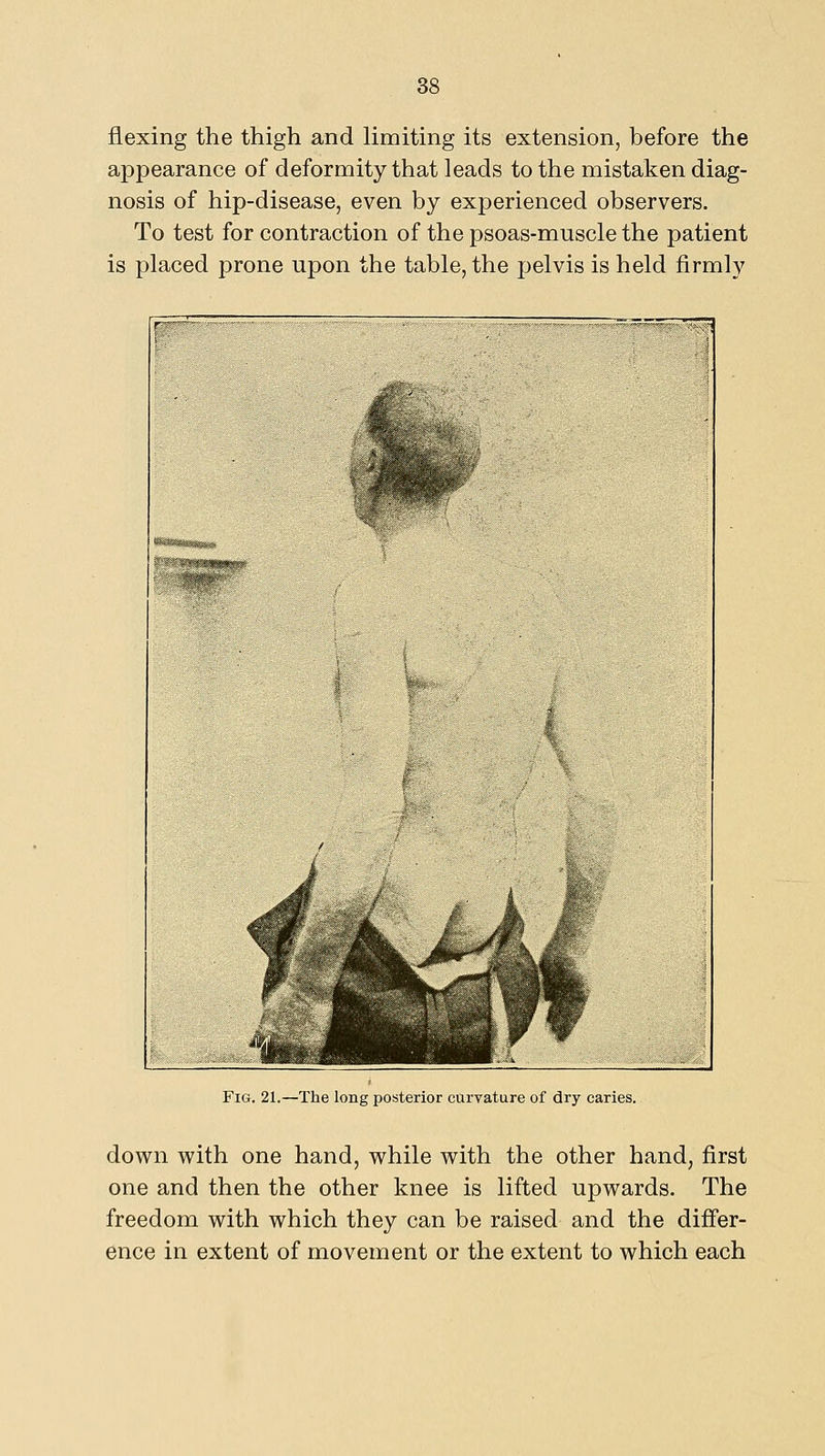 flexing the thigh and limiting its extension, before the appearance of deformity that leads to the mistaken diag- nosis of hip-disease, even by experienced observers. To test for contraction of the psoas-muscle the patient is placed prone upon the table, the pelvis is held firmly Fi(j. 21.—The long posterior curvature of dry caries. dov^^n with one hand, while with the other hand, first one and then the other knee is lifted upwards. The freedom with which they can be raised and the differ- ence in extent of movement or the extent to which each