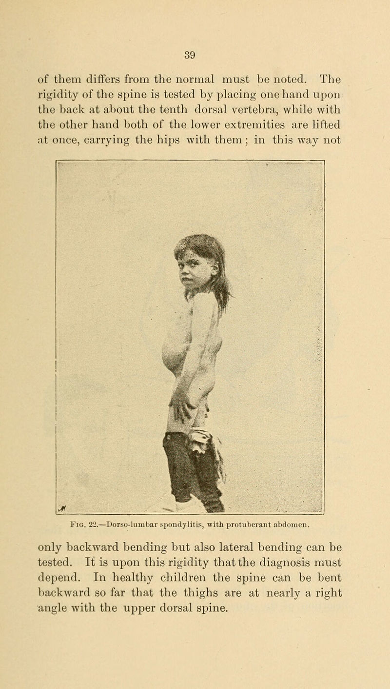 of them differs from the normal must be noted. The rigidity of the spine is tested by placing one hand upon the back at about the tenth dorsal vertebra, while with the other hand both of the lower extremities are lifted at once, carrying the hips with them; in this way not Fig. 22.—Dorso-lumbar spondylitis, with protuberant abdomen. only backward bending but also lateral bending can be tested. It is upon this rigidity that the diagnosis must depend. In healthy children the spine can be bent backward so far that the thighs are at nearly a right angle with the upper dorsal spine.