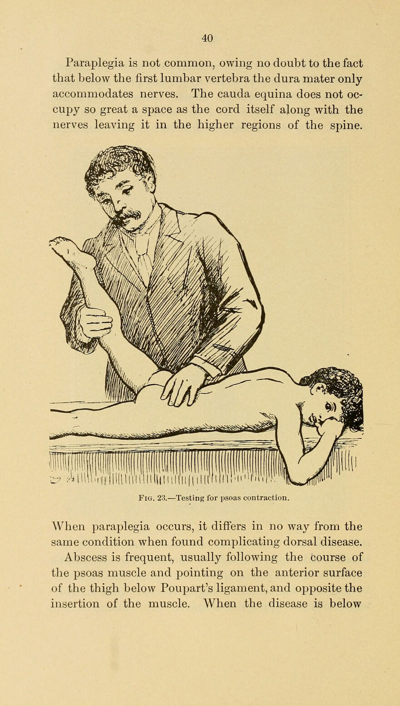Paraplegia is not common, owing no doubt to the fact that below the first lumbar vertebra the dura mater only accommodates nerves. The cauda equina does not oc- cupy so great a space as the cord itself along with the nerves leaving it in the higher regions of the spine. Fig. 23.—Testing for psoas contraction. When paraplegia occurs, it differs in no way from the same condition when found complicating dorsal disease. Abscess is frequent, usually following the course of the psoas muscle and pointing on the anterior surface of the thigh below Poupart's ligament, and opposite the insertion of the muscle. When the disease is below