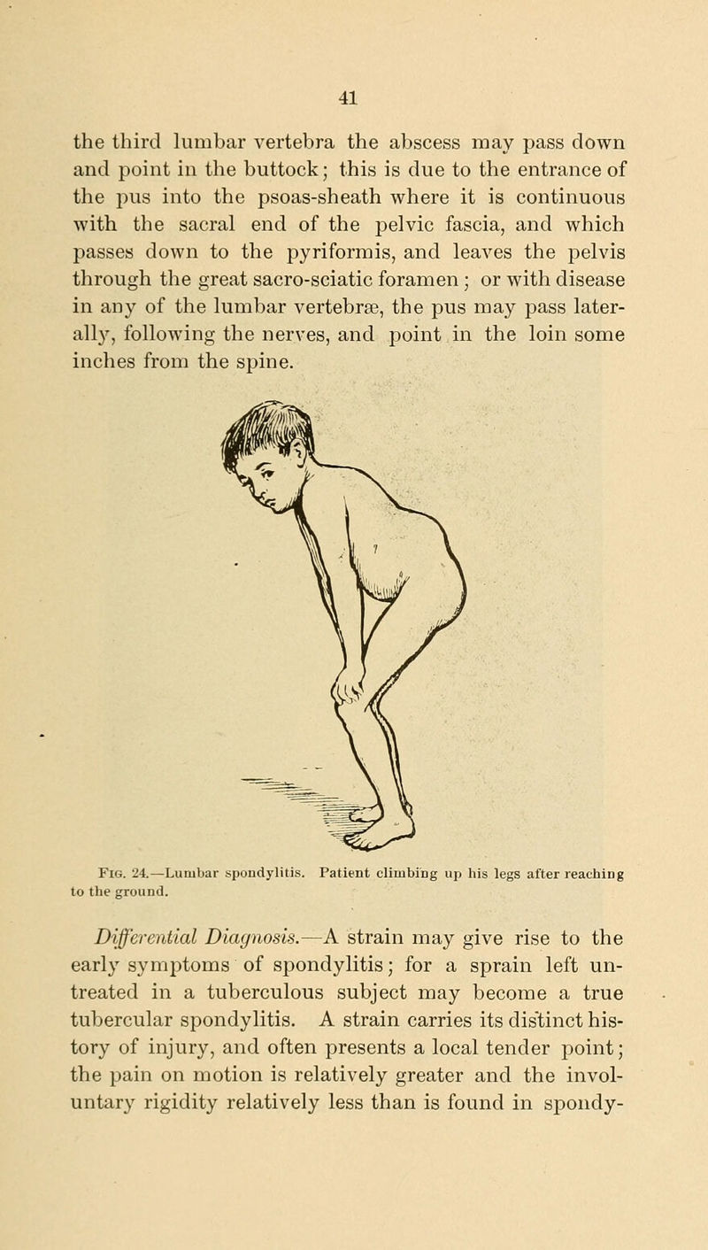 the third lumbar vertebra the abscess may pass down and point in the buttock; this is due to the entrance of the pus into the psoas-sheath where it is continuous with the sacral end of the pelvic fascia, and which passes down to the pyriformis, and leaves the pelvis through the great sacro-sciatic foramen; or with disease in any of the lumbar vertebrae, the pus may pass later- ally, following the nerves, and point in the loin some inches from the spine. Fig. 24.—Lumbar spondylitis. Patient climbing up his legs after reaching to the ground. Differential Diagnosis.—A strain may give rise to the early symptoms of spondylitis; for a sprain left un- treated in a tuberculous subject may become a true tubercular spondylitis. A strain carries its dis'tinct his- tory of injury, and often presents a local tender point; the pain on motion is relatively greater and the invol- untary rigidity relatively less than is found in spondy-