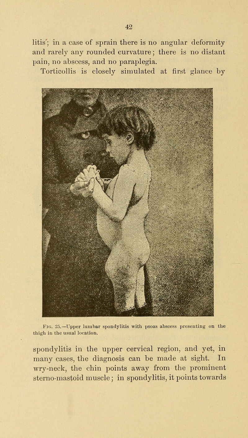 litis'; in a case of sprain there is no angular deformity and rarely any rounded curvature; there is no distant pain, no abscess, and no paraplegia. Torticollis is closely simulated at first glance by Fig. 25.—Upper lumbar spondylitis with psoas abscess presenting on the thigh in the usual location. spondylitis in the upper cervical region, and yet, in many cases, the diagnosis can be made at sight. In wry-neck, the chin points away from the prominent sterno-mastoid muscle; in spondylitis, it points towards