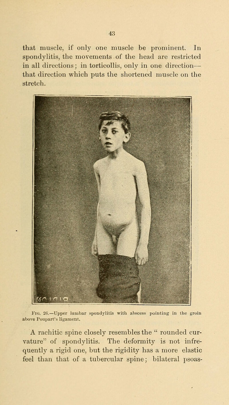 that muscle, if only one muscle be prominent. In spondylitis, the movements of the head are restricted in all directions; in torticollis, only in one direction— that direction which puts the shortened muscle on the stretch. Fig. 26.—Upper lumbar spondylitis with abscess pointiug in the groin above Poupart's ligament. A rachitic spine closely resembles the  rounded cur- vature of si3ondylitis. The deformity is not infre- quently a rigid one, but the rigidity has a more elastic feel than that of a tubercular spine; bilateral psoas-