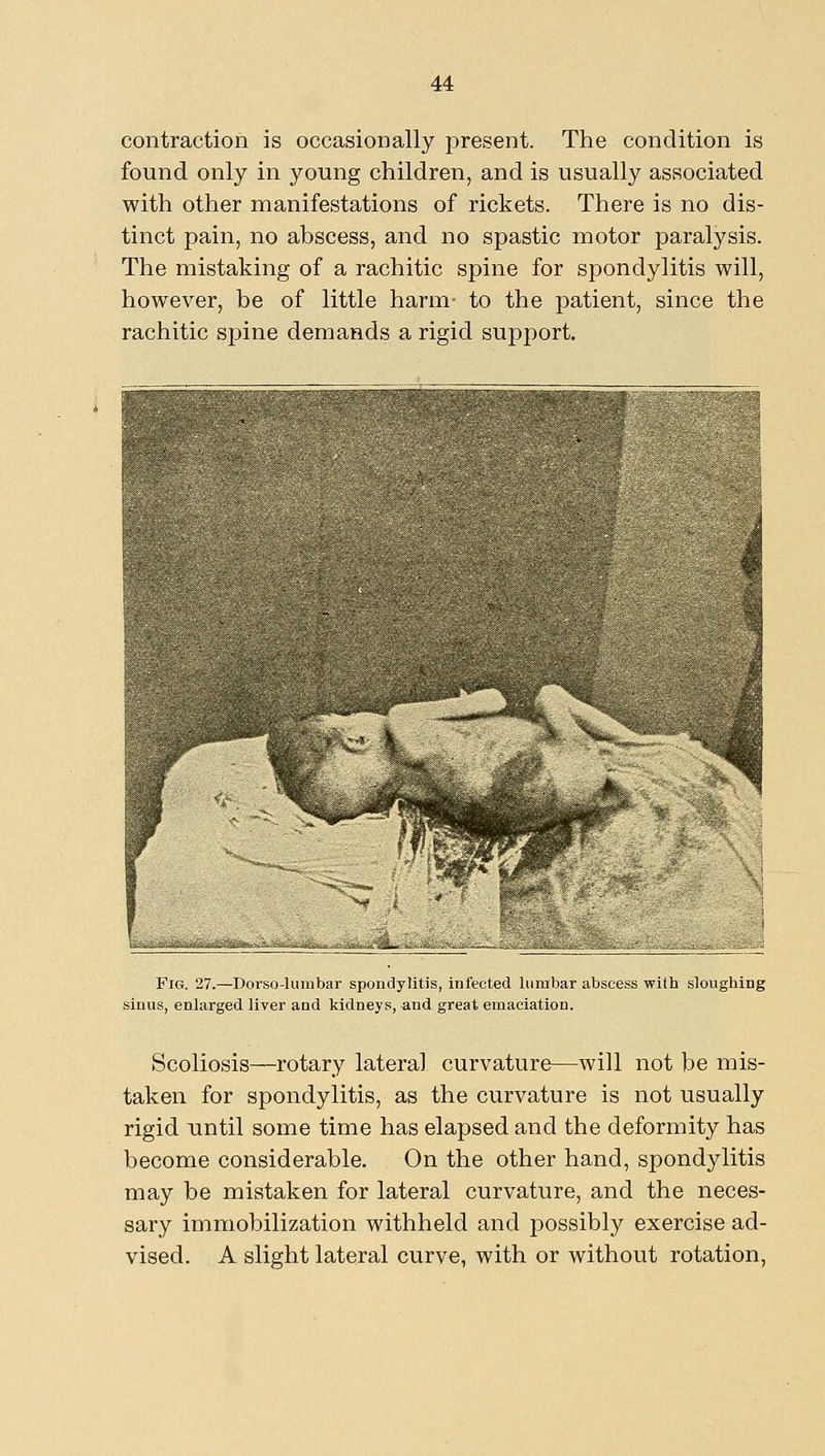 contraction is occasionally present. The condition is found only in young children, and is usually associated with other manifestations of rickets. There is no dis- tinct pain, no abscess, and no spastic motor paralysis. The mistaking of a rachitic spine for spondylitis will, however, be of little harm- to the patient, since the rachitic S]3ine demands a rigid support. Fig. 27.—Dorso-luinbar spondylitis, infected lumbar abscess with sloughing sinus, enlarged liver and kidneys, and great emaciation. Scoliosis—rotary lateral curvature—will not be mis- taken for spondylitis, as the curvature is not usually rigid until some time has elapsed and the deformity has become considerable. On the other hand, spondylitis may be mistaken for lateral curvature, and the neces- sary immobilization withheld and possibly exercise ad- vised. A slight lateral curve, with or without rotation,