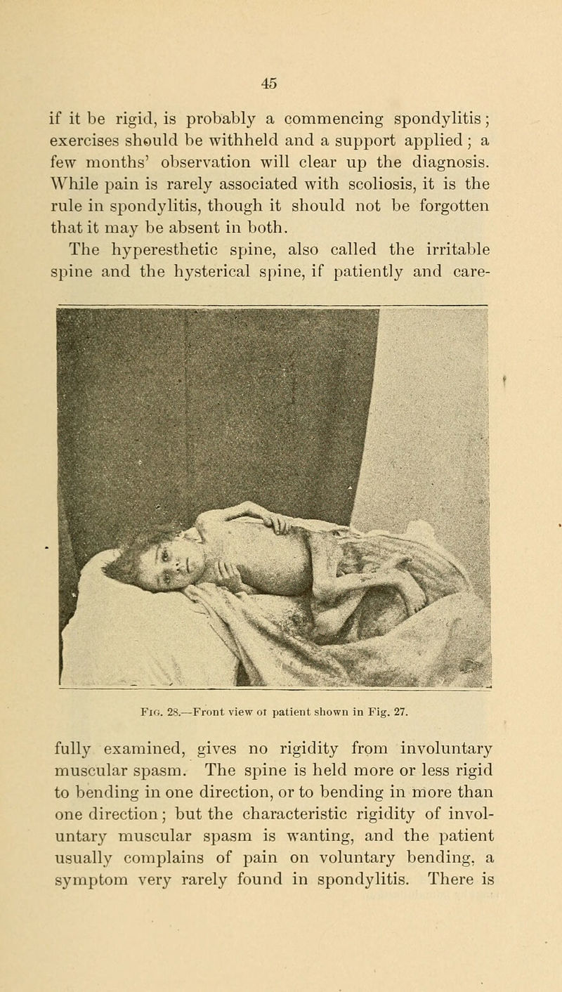 if it be rigid, is probably a commencing spondylitis; exercises should be withheld and a support applied ; a few months' observation will clear up the diagnosis. While pain is rarely associated with scoliosis, it is the rule in spondylitis, though it should not be forgotten that it may be absent in both. The hyperesthetic spine, also called the irritable spine and the hysterical spine, if patiently and care- Fir;. 28.—Front view ol patient shown in Fig. 27. fully examined, gives no rigidity from involuntary muscular spasm. The spine is held more or less rigid to bending in one direction, or to bending in more than one direction; but the characteristic rigidity of invol- untary muscular spasm is wanting, and the jiatient usually complains of pain on voluntary bending, a symptom very rarely found in spondylitis. There is