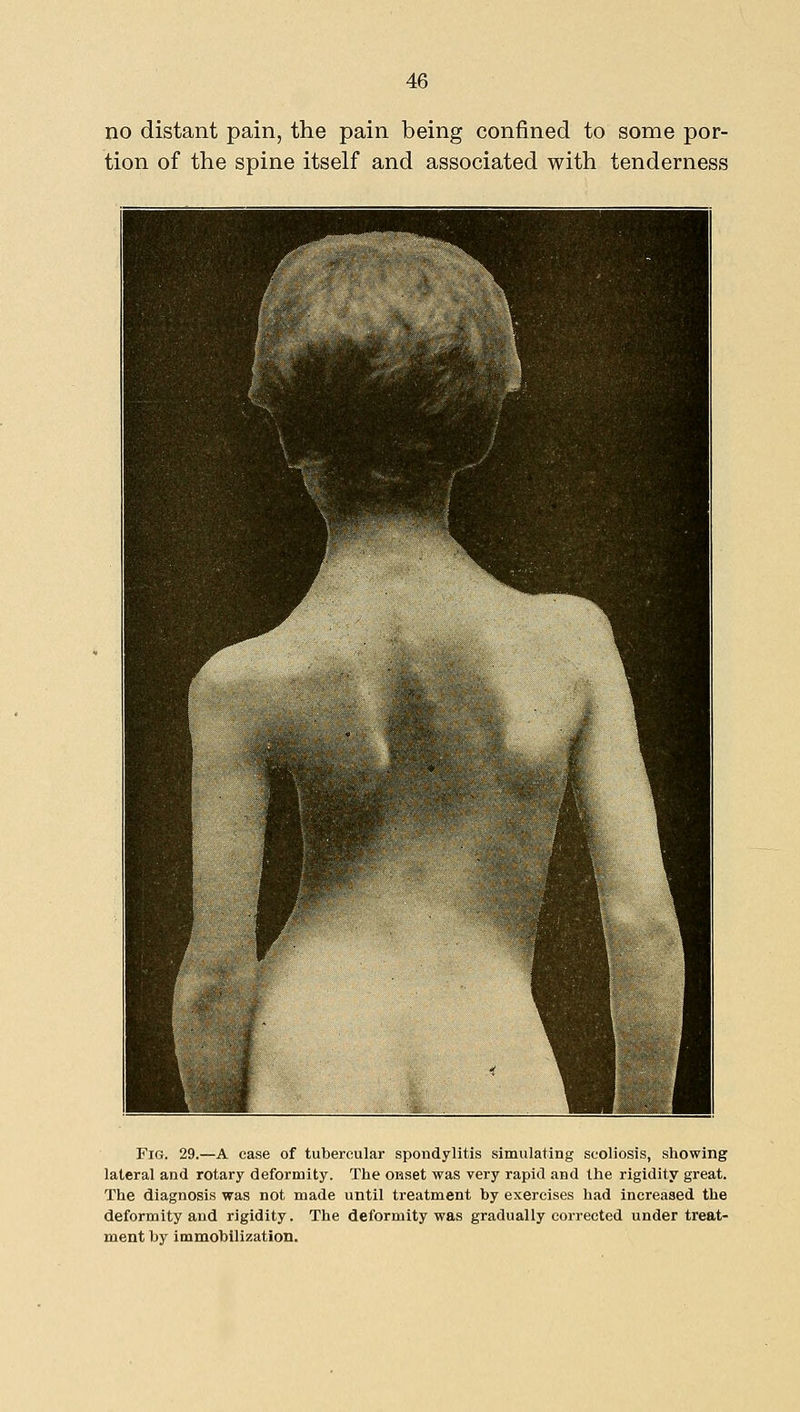 no tion distant pain, the pain being confined to some por- n of the spine itself and associated with tenderness Fig. 29.—A ease of tubercular spondylitis simulating scoliosis, showing lateral and rotary deformity. The onset was very rapid and the rigidity great. The diagnosis was not made until treatment by exercises had increased the deformity and rigidity. The deformity was gradually corrected under treat- ment by immobilization.