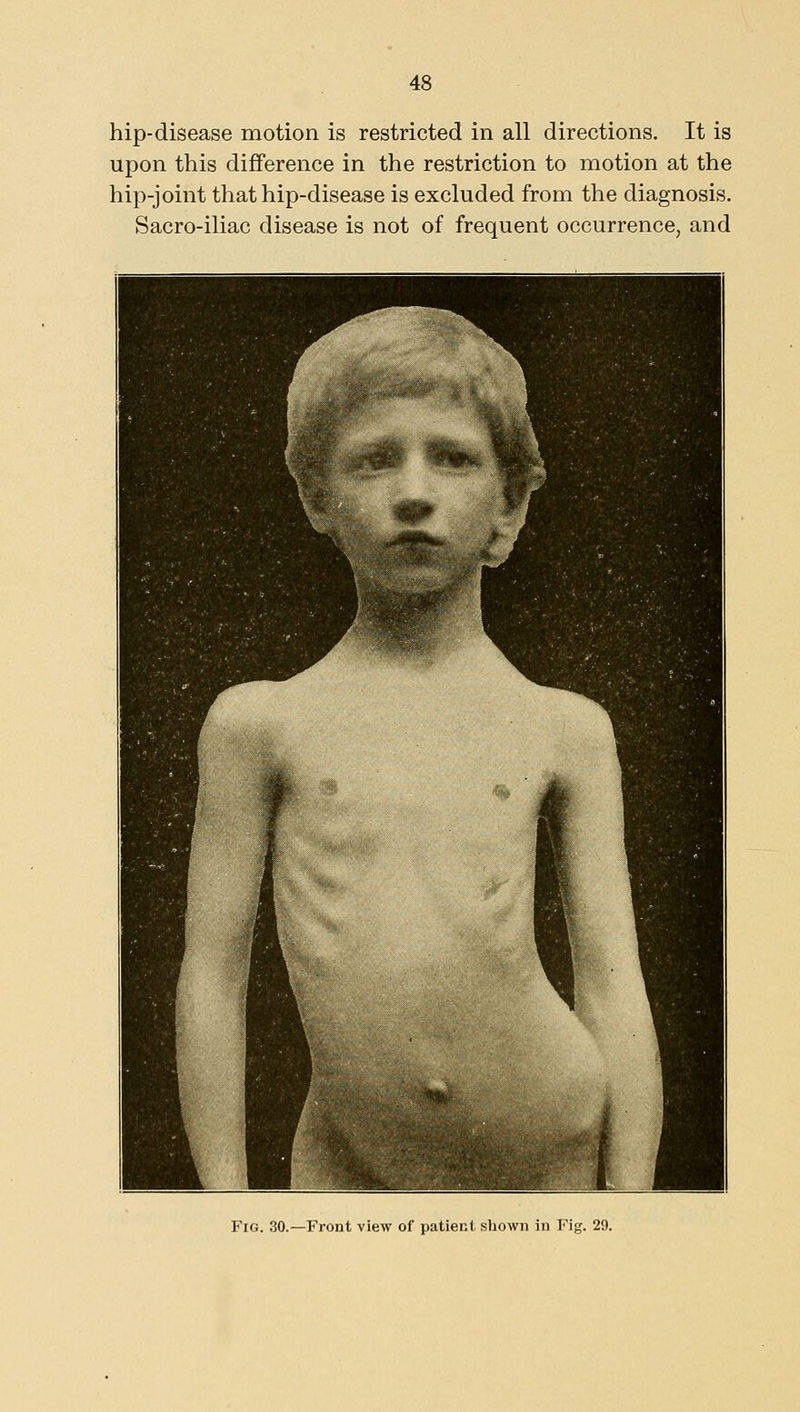 hip-disease motion is restricted in all directions. It is upon this difiference in the restriction to motion at the hip-joint that hip-disease is excluded from the diagnosis. Sacro-iliac disease is not of frequent occurrence, and Fig. 30.—Front view of patient shown in Fig. 29.