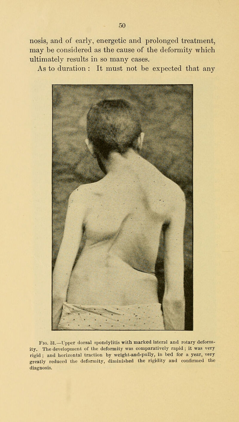 nosis, and of early, energetic and prolonged treatment, may be considered as the cause of the deformity which ultimately results in so many cases. As to duration : It must not be expected that any Fig. 31.—Upper dorsal spondylitis with marked lateral and rotary deform- ity. The development of the deformity was comparatively rapid; it was very rigid; and horizontal traction by weight-and-pully, in bed for a year, very greatly reduced the deformity, diminished the rigidity and confirmed the diagnosis.