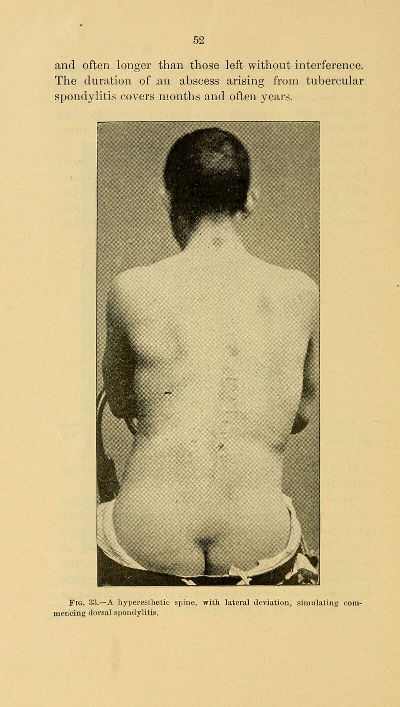 and often longer than those left without interference. The duration of an abscess arising from tubercular spondylitis covers months and often years. Fig. 33.—a hyperesthetic spine, with lateral deviation, simulating com- mencing dorsal spondylitis.