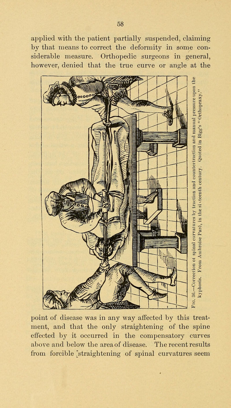 applied with the patient partially suspended, claiming by that means to correct the deformity in some con- siderable measure. Orthopedic surgeons in general, however, denied that the true curve or angle at the point of disease was in any way affected by this treat- ment, and that the only straightening of the spine effected by it occurred in the compensatory curves above and below the area of disease. The recent results from forcible [straightening of spinal curvatures seem