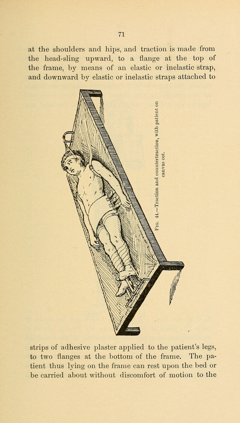 at the shoulders and hips, and traction is made from the head-sling upward, to a flange at the top of the frame, by means of an elastic or inelastic strap, and downward by elastic or inelastic straps attached to strips of adhesive plaster applied to the patient's legs, to two flanges at the bottom of the frame. The pa- tient thus lying on the frame can rest upon the bed or be carried about without discomfort of motion to the