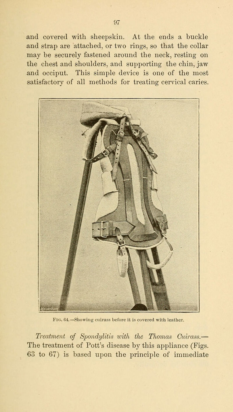 and covered with sheepskin. At the ends a buckle and strap are attached, or two rings, so that the collar may be securely fastened around the neck, resting on the chest and shoulders, and supporting the chin, jaw and occiput. This simple device is one of the most satisfactory of all methods for treating cervical caries. Fig. 64.—Showing cuirass before it is covered with leather. Treatment of Spondylitis ivith the Thomas Cuirass.— The treatment of Pott's disease by this appliance (Figs. 63 to 67) is based upon the principle of immediate