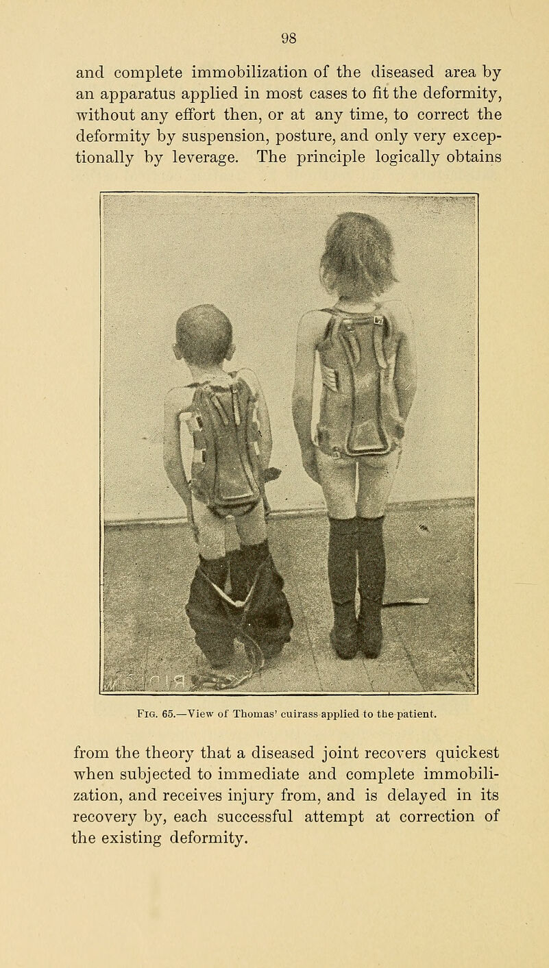 and complete immobilization of the diseased area by an apparatus applied in most cases to fit the deformity, without any effort then, or at any time, to correct the deformity by suspension, posture, and only very excep- tionally by leverage. The principle logically obtains Fig. 65.—View of Thomas' cuirass applied to the patient. from the theory that a diseased joint recovers quickest when subjected to immediate and complete immobili- zation, and receives injury from, and is delayed in its recovery bj^, each successful attempt at correction of the existing deformity.