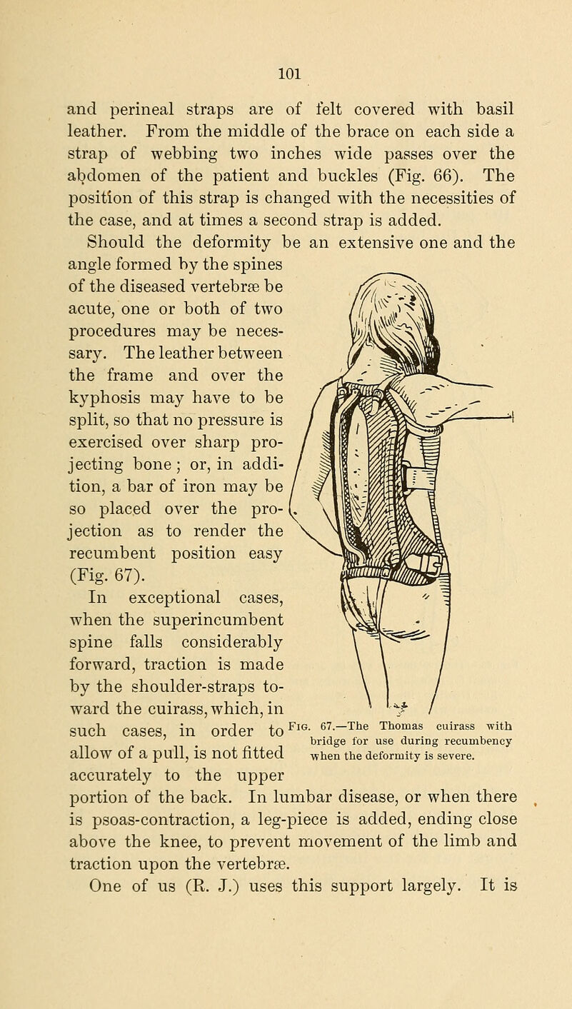 and perineal straps are of felt covered with basil leather. From the middle of the brace on each side a strap of webbing two inches wide passes over the abdomen of the patient and buckles (Fig. 66). The position of this strap is changed with the necessities of the case, and at times a second strap is added. Should the deformity be an extensive one and the angle formed by the spines of the diseased vertebrje be acute, one or both of two procedures may be neces- sary. The leather between the frame and over the kyphosis may have to be split, so that no pressure is exercised over sharp pro- jecting bone ; or, in addi- tion, a bar of iron may be so placed over the pro- jection as to render the recumbent position easy (Fig. 67). In exceptional cases, when the superincumbent spine falls considerably forward, traction is made by the shoulder-straps to- ward the cuirass, which, in such cases, in order to^'«- --^^^ ^^'''^^^ ^^^^'^ ^'^^ bridge for use during recumbency allow of a pull, is not fitted when the deformity is severe. accurately to the upper portion of the back. In lumbar disease, or when there is psoas-contraction, a leg-piece is added, ending close above the knee, to prevent movement of the limb and traction upon the vertebrse. One of us (R. J.) uses this support largely. It is
