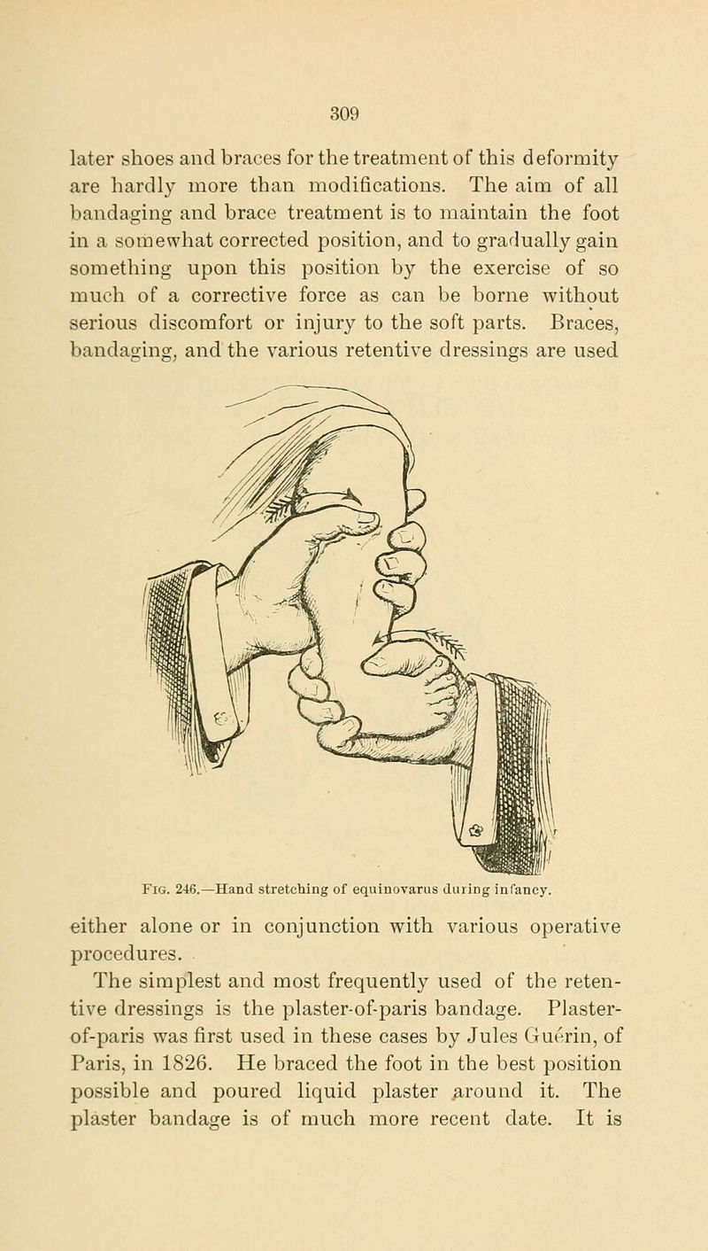 later shoes and braces for the treatment of this deformity are hardly more than modifications. The aim of all bandaging and brace treatment is to maintain the foot in a somewhat corrected position, and to gradually gain something upon this position by the exercise of so much of a corrective force as can be borne without serious discomfort or injury to the soft parts. Braces, bandaging, and the various retentive dressings are used Fig. 246.—Hand stretching of equinovarus during infancy. either alone or in conjunction with various operative procedures. . The simplest and most frequently used of the reten- tive dressings is the plaster-of-paris bandage. Plaster- of-paris was first used in these cases by Jules Guerin, of Paris, in 1826. He braced the foot in the best position possible and poured liquid plaster ground it. The plaster bandage is of much more recent date. It is