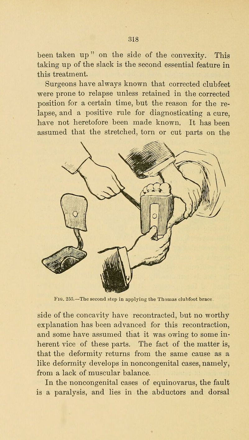 been taken up  on the side of the convexity. This taking up of the slack is the second essential feature in this treatment. Surgeons have always known that corrected clubfeet were prone to relapse unless retained in the corrected position for a certain time, but the reason for the re- lapse, and a positive rule for diagnosticating a cure, have not heretofore been made known. It has been assumed that the stretched, torn or cut parts on the Fig. 255.—The second step in applying the Thomas clubfoot brace. side of the concavity have recontracted, but no worthy explanation has been advanced for this recontraction, and some have assumed that it was owing to some in- herent vice of these parts. The fact of the matter is, that the deformity returns from the same cause as a like deformity develops in noncongenital cases, namely, from a lack of muscular balance. In the noncongenital cases of equinovarus, the fault is a paralysis, and lies in the abductors and dorsal