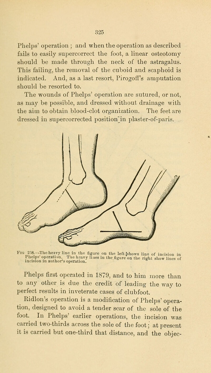 Phelps' operation ; and when the operation as described fails to easily supercorrect the foot, a linear osteotomy should be made through the neck of the astragalus. This failing, the removal of the cuboid and scaphoid is indicated. And, as a last resort, Pirogofif's amputation should be resorted to. The wounds of Phelps' operation are sutured, or not, as may be possible, and dressed without drainage with the aim to obtain blood-clot organization. The feet are dressed in supercorrected position~in plaster-of-paris. ^^'^T^u'^r'^'^®'^®^.^^^'^'' ^° *^® 'isure on the left Jshows line of incision in Piielps' operati.>n. The heavy liues in the figure on the right show lines of incision in author's operation. Phelps first operated in 1879, and to him more than to any other is due the credit of leading the way to perfect results in inveterate cases of clubfoot. Ridlon's operation is a modification of Phelps' opera- tion, designed to avoid a tender scar of the sole of the foot. In Phelps' earlier operations, the incision was carried two-thirds across the sole of the foot; at present it is carried but one-third that distance, and the objec-