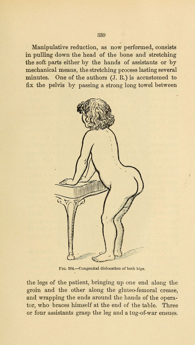 Manipulative reduction, as now performed, consists in pulling down the head of the bone and stretching the soft parts either by the hands of assistants or by mechanical means, the stretching process lasting several minutes. One of the authors (J. R.) is accustomed to fix the pelvis by passing a strong long towel between Fig. 264.—Congenital dislocation of both hips. the legs of the patient, bringing up one end along the groin and the other along the gluteo-femoral crease, and wrapping the ends around the hands of the opera- tor, who braces himself at the end of the table. Three or four assistants grasp the leg and a tug-of-war ensues.