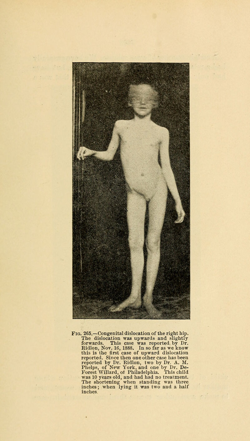 Fig. 265.—Congenital dislocation of the right hip. The dislocation was upwards and slightly forwards. This case was reported by Dr. Eidlon, Nov. 16, 1888. In so far as we know this is the first case of upward dislocation reported. Since then one other case has been reported by Dr. Ridlon, two by Dr. A. M. Phelps, of New York, and one by Dr. De- Forest Willard, of Philadelphia. This child was 10 years old, and had had no treatment. The shortening when standing was three inches; when lying it was two and a half inches.