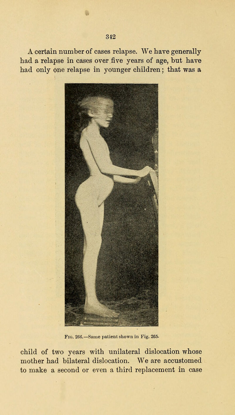 A certain number of cases relapse. We have generally had a relapse in cases over five years of age, but have had only one relapse in younger children; that was a Fig. 266.—Same patient shown in Fig. 265- child of two years with unilateral dislocation whose mother had bilateral dislocation. We are accustomed to make a second or even a third replacement in case