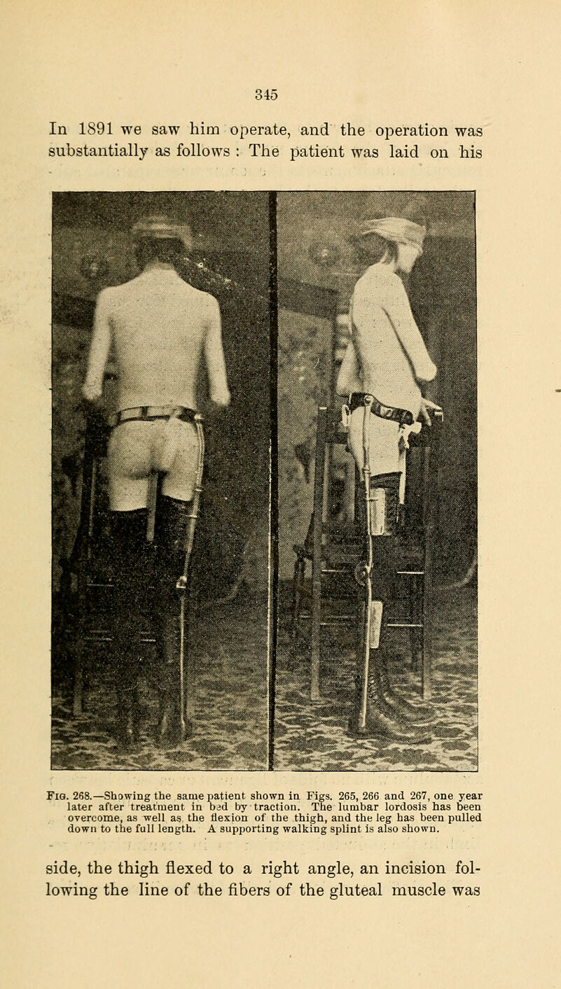 In 1891 we saw him operate, and the operation was substantially as follows : The patient was laid on his Fig. 268.—Showing the same patient shown in Figs. 265, 266 and 267, one year later after treatment in bad by traction. The lumbar lordosis has been overcome, as well as the flexion of the thigh, and the leg has been pulled down to the full length. A supporting walking splint is also shown. side, the thigh flexed to a right angle, an incision fol- lowing the line of the fibers of the gluteal muscle was