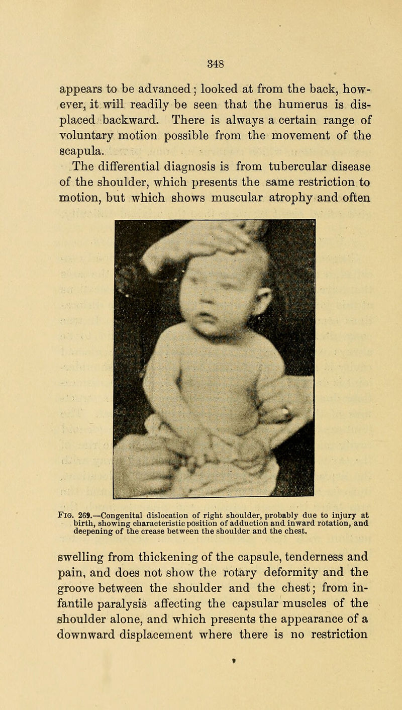 appears to be advanced; looked at from the back, how- ever, it will readily be seen that the humerus is dis- placed backward. There is always a certain range of voluntary motion possible from the movement of the scapula. The differential diagnosis is from tubercular disease of the shoulder, which presents the same restriction to motion, but which shows muscular atrophy and often Fig. 269.—Congenital dislocation of right shoulder, probably due to injury at birth, showing characteristic position of adduction and inward rotation, and deepening of the crease between the shoulder and the chest. swelling from thickening of the capsule, tenderness and pain, and does not show the rotary deformity and the groove between the shoulder and the chest; from in- fantile paralysis affecting the capsular muscles of the shoulder alone, and which presents the appearance of a downward displacement where there is no restriction