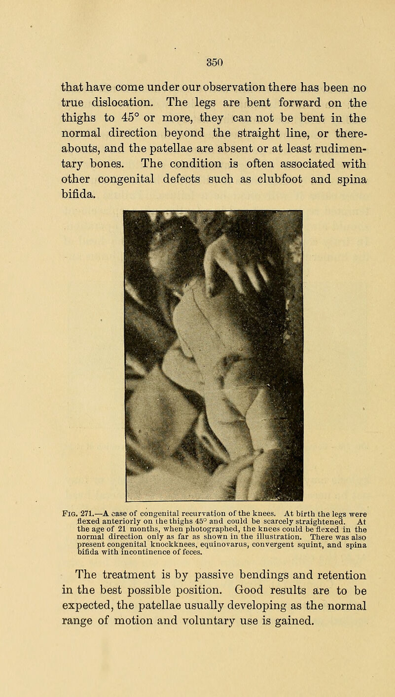 that have come under our observation there has been no true dislocation. The legs are bent forward on the thighs to 45° or more, they can not be bent in the normal direction beyond the straight line, or there- abouts, and the patellae are absent or at least rudimen- tary bones. The condition is often associated with other congenital defects such as clubfoot and spina bifida. Fig. 271.—A case of congenital recurvation of the knees. At birth the legs were flexed anteriorly on ihe thighs 45° and could be scarcely straightened. At the age of 21 months, when photographed, the knees could be flexed in the normal direction only as far as shown in the illustration. There was also present congenital knockknees, equinovarus, convergent squint, and spina bifida with incontinence of feces. The treatment is by passive bendings and retention in the best possible position. Good results are to be expected, the patellae usually developing as the normal range of motion and voluntary use is gained.