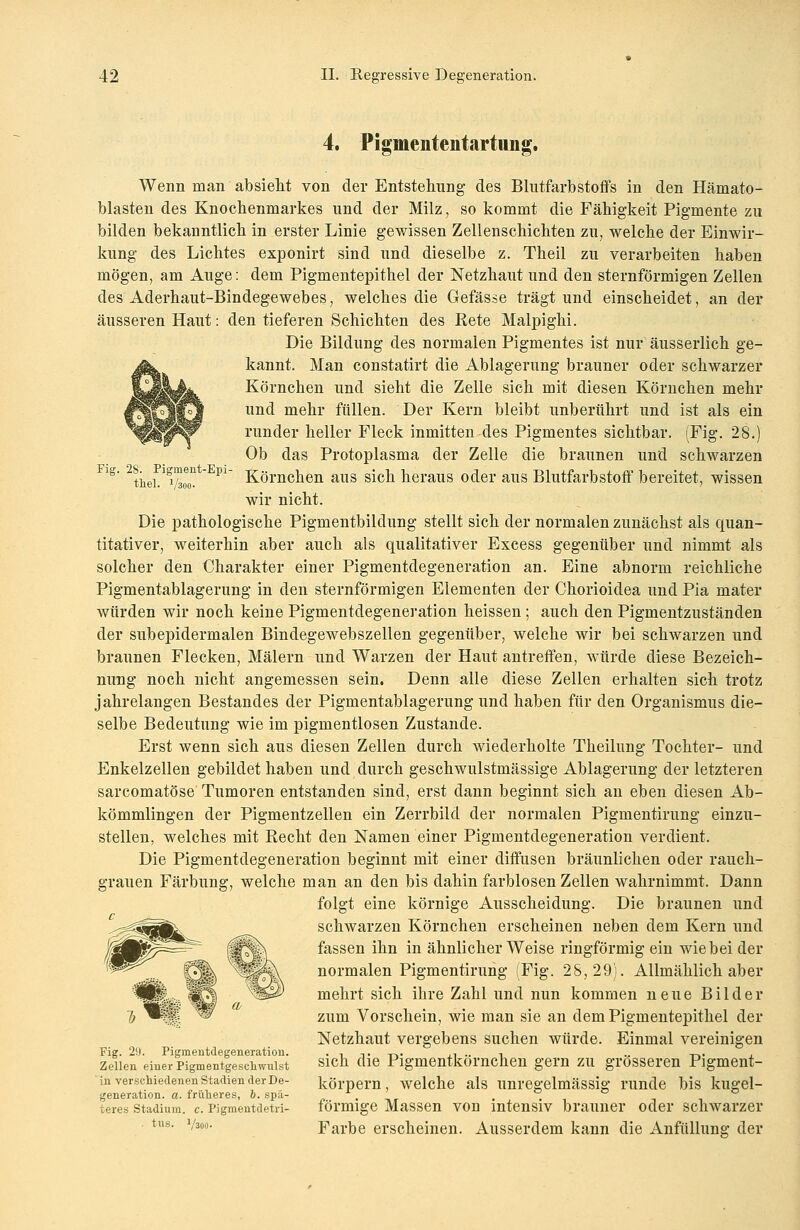 4. Pigmententartung. Fig. 28. Pigment-Epi- thel. V300- Wenn man absieht von der Entstehung des Blutfarbstoffs in den Hämato- blasten des Knochenmarkes und der Milz, so kommt die Fähigkeit Pigmente zu bilden bekanntlich in erster Linie gewissen Zellenschichten zu, welche der Einwir- kung des Lichtes exponirt sind und dieselbe z. Theil zu verarbeiten haben mögen, am Auge: dem Pigmentepithel der Netzhaut und den sternförmigen Zellen des Aderhaut-Bindegewebes, welches die Gefässe trägt und einscheidet, an der äusseren Haut: den tieferen Schichten des Bete Malpighi. Die Bildung des normalen Pigmentes ist nur äusserlich ge- kannt. Man constatirt die Ablagerung brauner oder schwarzer Körnchen und sieht die Zelle sich mit diesen Körnchen mehr und mehr füllen. Der Kern bleibt unberührt und ist als ein runder heller Fleck inmitten des Pigmentes sichtbar. (Fig. 28.) Ob das Protoplasma der Zelle die braunen und schwarzen Körnchen aus sich heraus oder aus Blutfarbstoff bereitet, wissen wir nicht. Die pathologische Pigmentbildung stellt sich der normalen zunächst als quan- titativer, weiterhin aber auch als qualitativer Excess gegenüber und nimmt als solcher den Charakter einer Pigmentdegeneration an. Eine abnorm reichliche Pigmentablagerung in den sternförmigen Elementen der Chorioidea und Pia mater würden wir noch keine Pigmentdegeneration heissen; auch den Pigmentzuständen der subepidermalen Bindegewebszellen gegenüber, welche wir bei schwarzen und braunen Flecken, Malern und Warzen der Haut antreffen, würde diese Bezeich- nung noch nicht angemessen sein. Denn alle diese Zellen erhalten sich trotz jahrelangen Bestandes der Pigmentablagerung und haben für den Organismus die- selbe Bedeutung wie im pigmentlosen Zustande. Erst wenn sich aus diesen Zellen durch wiederholte Theilung Tochter- und Enkelzellen gebildet haben und durch geschwulstmässige Ablagerung der letzteren sarcomatöse Tumoren entstanden sind, erst dann beginnt sich an eben diesen Ab- kömmlingen der Pigmentzellen ein Zerrbild der normalen Pigmentirung einzu- stellen, welches mit Recht den Namen einer Pigmentdegeneration verdient. Die Pigmentdegeneration beginnt mit einer diffusen bräunlichen oder rauch- grauen Färbung, welche man an den bis dahin farblosen Zellen wahrnimmt. Dann folgt eine körnige Ausscheidung. Die braunen und schwarzen Körnchen erscheinen neben dem Kern und fassen ihn in ähnlicher Weise ringförmig ein wie bei der normalen Pigmentirung (Fig. 28,29). Allmählich aber mehrt sich ihre Zahl und nun kommen neue Bilder zum Vorschein, wie man sie an dem Pigmentepithel der Netzhaut vergebens suchen würde. Einmal vereinigen sich die Pigmentkörnchen gern zu grösseren Pigment- körpern, welche als unregelmässig runde bis kugel- förmige Massen von intensiv brauner oder schwarzer Farbe erscheinen. Ausserdem kann die Anfüllung der Fig. 2(J. Pigmentdegeneratioii. Zellen einer Pigmentgeschwulst in verschiedenen Stadien der De- generation, a. früheres, 6. spä- teres Stadium, c. Pigmentdetri- . tus. Väoo-