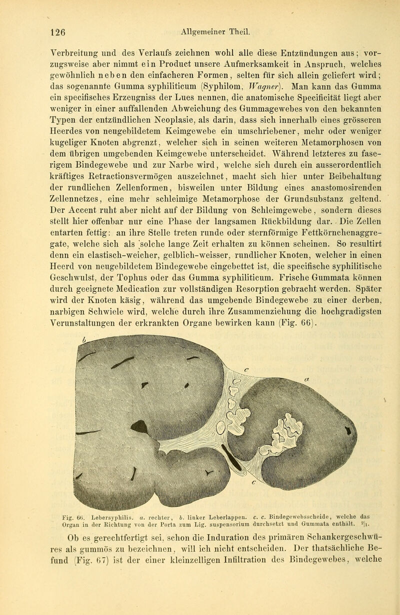 Verbreitung und des Verlaufs zeichnen wohl alle diese Entzündungen aus; vor- zugsweise aber nimmt ein Product unsere Aufmerksamkeit in Anspruch, welches gewöhnlich neben den einfacheren Formen, selten für sich allein geliefert wird; das sogenannte Gumma syphiliticum (Syphilom, Wagner). Man kann das Gumma ein specifisches Erzeugniss der Lues nennen, die anatomische Specificität liegt aber weniger in einer auffallenden Abweichung des Gummagewebes von den bekannten Typen der entzündlichen Neoplasie, als darin, dass sich innerhalb eines grösseren Heerdes von neugebildetem Keimgewebe ein umschriebener, mehr oder weniger kugeliger Knoten abgrenzt, welcher sich in seinen weiteren Metamorphosen von dem übrigen umgebenden Keimgewebe unterscheidet. Während letzteres zu fase- rigem Bindegewebe und zur Narbe wird, welche sich durch ein ausserordentlich kräftiges Retractionsvermögen auszeichnet, macht sich hier unter Beibehaltung der rundlichen Zellenformen, bisweilen unter Bildung eines anastomosirenden Zellennetzes, eine mehr schleimige Metamorphose der Grundsubstanz geltend. Der Accent ruht aber nicht auf der Bildung von Schleimgewebe, sondern dieses stellt hier offenbar nur eine Phase der langsamen Rückbildung dar. Die Zellen entarten fettig: an ihre Stelle treten runde oder sternförmige Fettkörnchenaggre- gate, welche sich als [solche lange Zeit erhalten zu können scheinen. So resultirt denn ein elastisch-weicher, gelblich-weisser, rundlicher Knoten, welcher in einen Heerd von neugebildetem Bindegewebe eingebettet ist, die specifische syphilitische Geschwulst, der Tophus oder das Gumma syphiliticum. Frische Gummata können durch geeignete Medication zur vollständigen Resorption gebracht werden. Später wird der Knoten käsig, während das umgebende Bindegewebe zu einer derben, narbigen Schwiele wird, welche durch ihre Zusammenziehung die hochgradigsten Verunstaltungen der erkrankten Organe bewirken kann (Fig. 66). . .■.. ■■■■ :.■ ■-■■; 1^ IHI'' c^~ yv jfr' %k. 1 Cl ■''/~\ hJ> ' xSßß' itfer :<p\ «lllllli ^W ■PT w | ^..pr ?Ä •i n;; ,y;\,,E:;v',v Fig. 6(i. Lebersyphilis, a. rechter, b. linker Leberlappen. c. c. Bindegewebsscheide, welche das Organ in der Richtung von der Porta zum Lig. Suspensorium durchsetzt und Gummata enthält. 'z\\. Ob es gerechtfertigt sei, schon die Induration des primären Schankergeschwü- res als gummös zu bezeichnen, will ich nicht entscheiden. Der thatsächliche Be- fund (Fig. 67) ist der einer kleinzelligen Infiltration des Bindegewebes, welche