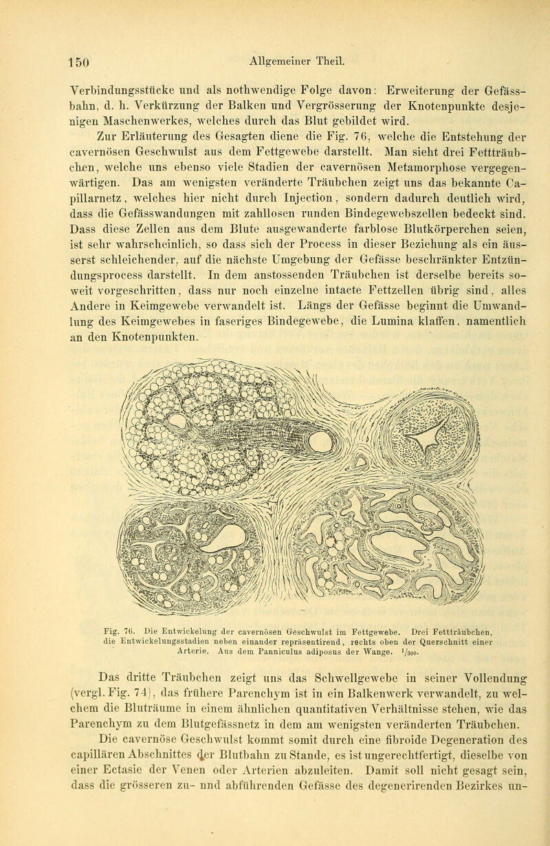 Verbindungsstücke und. als nothwendige Folge davon: Erweiterung der Gefäss- bahn, d. h. Verkürzung der Balken und Vergrösserung der Knotenpunkte desje- nigen Masebenwerkes, welcbes dureb das Blut gebildet wird. Zur Erläuterung des Gesagten diene die Fig. 76, welche die Entstehung der cavernösen Geschwulst aus dem Fettgewebe darstellt. Man siebt drei Fettträub- chen, welche uns ebenso viele Stadien der cavernösen Metamorphose vergegen- wärtigen. Das am wenigsten veränderte Träubchen zeigt uns das bekannte Ca- pillarnetz, welches hier nicht durch Injection, sondern dadurch deutlich wird, dass die Gefässwandungen mit zahllosen runden Bindegewebszellen bedeckt sind. Dass diese Zellen aus dem Blute ausgewanderte farblose Blutkörperchen seien, ist sehr wahrscheinlich, so dass sich der Process in dieser Beziehung als ein äus- serst schleichender, auf die nächste Umgebung der Gefässe beschränkter Entzün- dungsprocess darstellt. In dem anstossenden Träubchen ist derselbe bereits so- weit vorgeschritten, dass nur noch einzelne intacte Fettzellen übrig sind, alles Andere in Keimgewebe verwandelt ist. Längs der Gefässe beginnt die Umwand- lung des Keimgewebes in faseriges Bindegewebe, die Lumina klaffen, namentlich an den Knotenpunkten. Fig. 76. Oie Elitwickelung der cavernösen Geschwulst im Fettgewebe. Drei Fettträubchen, die Entwickelungsstadien neben einander repräsentirend, rechts oben der Querschnitt einer Arterie. Aus dem Panniculus adiposus der Wange. Vsoo- Das dritte Träubchen zeigt uns das Schwellgewebe in seiner Vollendung (vergl.Fig. 74), das frühere Parenchym ist in ein Balkenwerk verwandelt, zu wel- chem die Bluträume in einem ähnlichen quantitativen Verhältnisse stehen, wie das Parenchym zu dem Blutgefässnetz in dem am wenigsten veränderten Träubchen. Die cavernöse Geschwulst kommt somit durch eine fibroide Degeneration des capillären Abschnittes 4er Blutbahn zu Stande, es ist ungerechtfertigt, dieselbe von einer Ectasie der Venen oder Arterien abzuleiten. Damit soll nicht gesagt sein, dass die grösseren zu- nnd abführenden Gefässe des degenerirenden Bezirkes un-