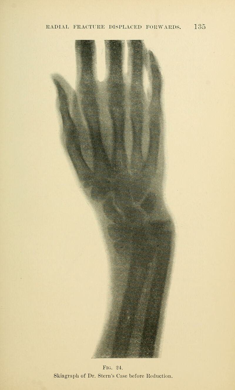 Fig. 24. Skiagraph of Dr. Stern's Case before Reduction.