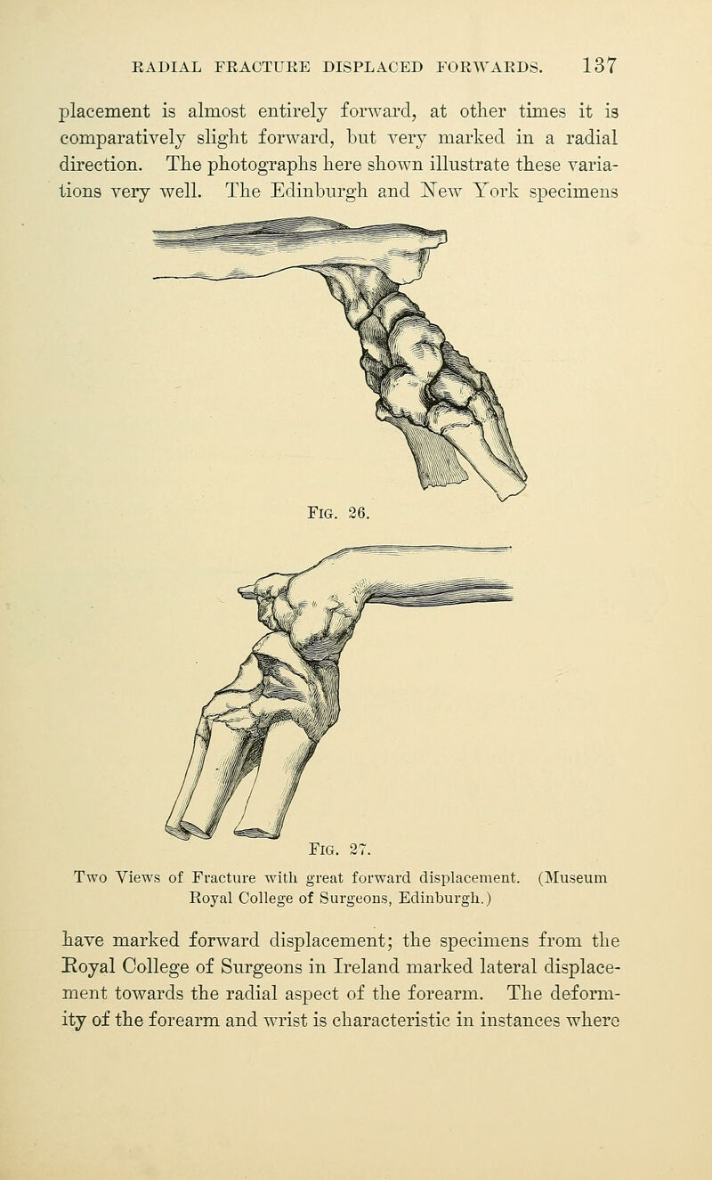 placement is almost entirely forward, at other times it is comparatively slight forward, but very marked in a radial direction. The photographs here shown illustrate these varia- tions very well. The Edinburgh and ISTew York specimens Fig. 26. Fig. 27. Two Views of Fracture with great forward displacement. Royal College of Surgeons, Edinburgh.) (Museum have marked forward displacement; the specimens from the Koyal College of Surgeons in Ireland marked lateral displace- ment towards the radial aspect of the forearm. The deform- ity of the forearm and wrist is characteristic in instances where