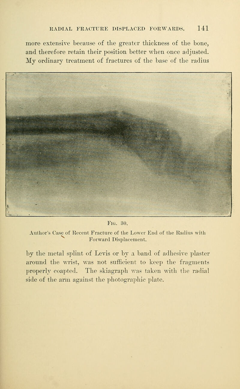 more extensive because of the greater thickness of the bone, and therefore retain their position better when once adjusted. My ordinary treatment of fractures of the base of the radius Fig. 30. Author's Case of Recent Fracture of the Lower End of the Radius with Forward Displacement. by the metal splint of Levis or by a band of adhesive plaster around the wrist, was not sufficient to keep the fragments properly coapted. The skiagraph was taken with the radial side of the ami against the photographic plate.