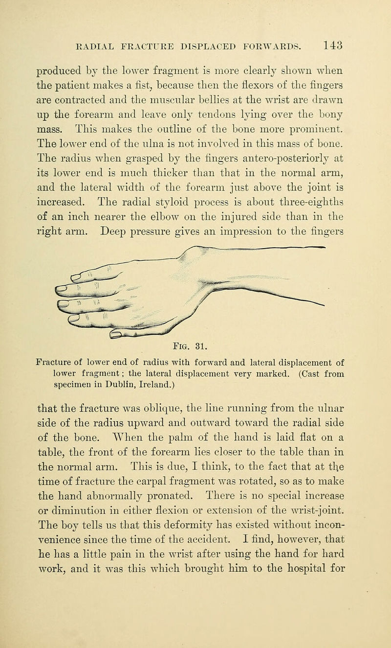 produced by the lower fragment is more clearly shown when the patient makes a fist, because then the flexors of the fingers are contracted and the muscular bellies at the wrist are drawn up the forearm and leave only tendons lying over the bony mass. This makes the outline of the bone more prominent. The lower end of the ulna is not involved in this mass of bone. The radius when grasped by the fingers antero-posteriorly at its lower end is much thicker than that in the normal arm, and the lateral width of the forearm just above the joint is increased. The radial styloid process is about three-eighths of an inch nearer the elbow on the injured side than in the right arm. Deep pressure gives an impression to the fingers Fig. 31. Fracture of lower end of radius with forward and lateral displacement of lower fragment; the lateral displacement very marked. (Cast from specimen in Dublin, Ireland.) that the fracture was oblique, the line running from the ulnar side of the radius upward and outward toward the radial side of the bone. When the palm of the hand is laid flat on a table, the front of the forearm lies closer to the table than in the normal arm. This is due, I think, to the fact that at the time of fracture the carpal fragment was rotated, so as to make the hand abnormally pronated. There is no special increase or diminution in either flexion or extension of the wrist-joint. The boy tells us that this deformity has existed without incon- venience since the time of the accident. I find, however, that he has a little pain in the wrist after using the hand for hard work, and it was this which brought him to the hospital for