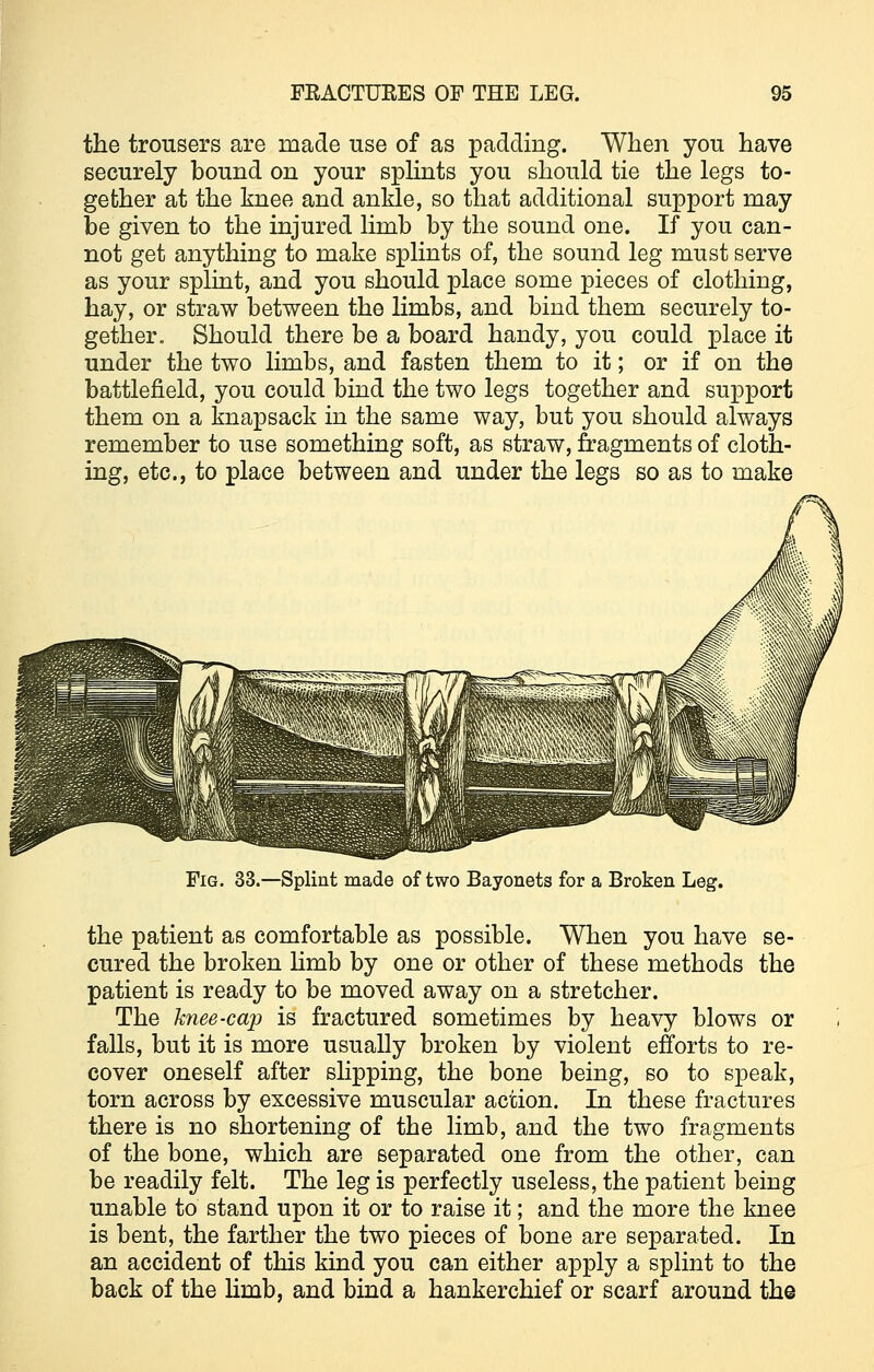 the trousers are made use of as padding. When you have securely bound on your splints you should tie the legs to- gether at the knee and ankle, so that additional support may be given to the injured limb by the sound one. If you can- not get anything to make splints of, the sound leg must serve as your splint, and you should place some pieces of clothing, hay, or straw between the limbs, and bind them securely to- gether. Should there be a board handy, you could place it under the two limbs, and fasten them to it; or if on the battlefield, you could bind the two legs together and support them on a knapsack in the same way, but you should always remember to use something soft, as straw, fragments of cloth- ing, etc., to place between and under the legs so as to make Fig. 33.—Splint made of two Bayonets for a Broken Leg. the patient as comfortable as possible. When you have se- cured the broken limb by one or other of these methods the patient is ready to be moved away on a stretcher. The knee-cap is fractured sometimes by heavy blows or falls, but it is more usually broken by violent efforts to re- cover oneself after slipping, the bone being, so to speak, torn across by excessive muscular action. In these fractures there is no shortening of the limb, and the two fragments of the bone, which are separated one from the other, can be readily felt. The leg is perfectly useless, the patient being unable to stand upon it or to raise it; and the more the knee is bent, the farther the two pieces of bone are separated. In an accident of this kind you can either apply a splint to the back of the limb, and bind a hankerchief or scarf around the