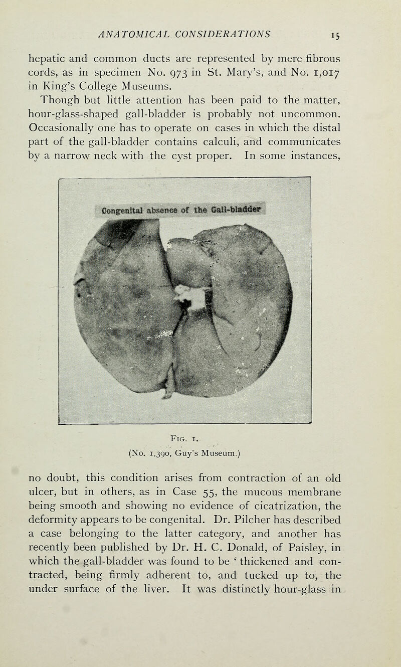 hepatic and common ducts are represented by mere fibrous cords, as in specimen No. 973 in St. Mary's, and No. 1,017 in King's College Museums. Though but little attention has been paid to the matter, hour-glass-shaped gall-bladder is probably not uncommon. Occasionally one has to operate on cases in which the distal part of the gall-bladder contains calculi, and communicates by a narrow neck with the cyst proper. In some instances, Fig. 1. (No. 1,390, Guy's Museum. no doubt, this condition arises from contraction of an old ulcer, but in others, as in Case 55, the mucous membrane being smooth and showing no evidence of cicatrization, the deformity appears to be congenital. Dr. Pilcher has described a case belonging to the latter category, and another has recently been published by Dr. H. C. Donald, of Paisley, in which the gall-bladder was found to be ' thickened and con- tracted, being firmly adherent to, and tucked up to, the under surface of the liver. It was distinctly hour-glass in