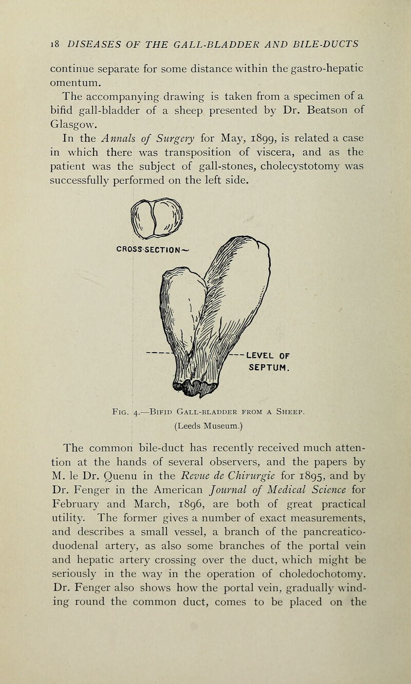 continue separate for some distance within the gastro-hepatic omentum. The accompanying drawing is taken from a specimen of a bifid gall-bladder of a sheep presented by Dr. Beatson of Glasgow. In the Annals of Surgery for May, 1899, is related a case in which there was transposition of viscera, and as the patient was the subject of gall-stones, cholecystotomy was successfully performed on the left side. CROSS SECTION^ — LEVEL OF SEPTUM. Fig. 4.—Bifid Gall-bladder from a Sheep. (Leeds Museum.) The common bile-duct has recently received much atten- tion at the hands of several observers, and the papers by M. le Dr. Quenu in the Revue de Chirurgie for 1895, and by Dr. Fenger in the American Journal of Medical Science for February and March, 1896, are both of great practical utility. The former gives a number of exact measurements, and describes a small vessel, a branch of the pancreatico- duodenal artery, as also some branches of the portal vein and hepatic artery crossing over the duct, which might be seriously in the way in the operation of choledochotomy. Dr. Fenger also shows how the portal vein, gradually wind- ing round the common duct, comes to be placed on the
