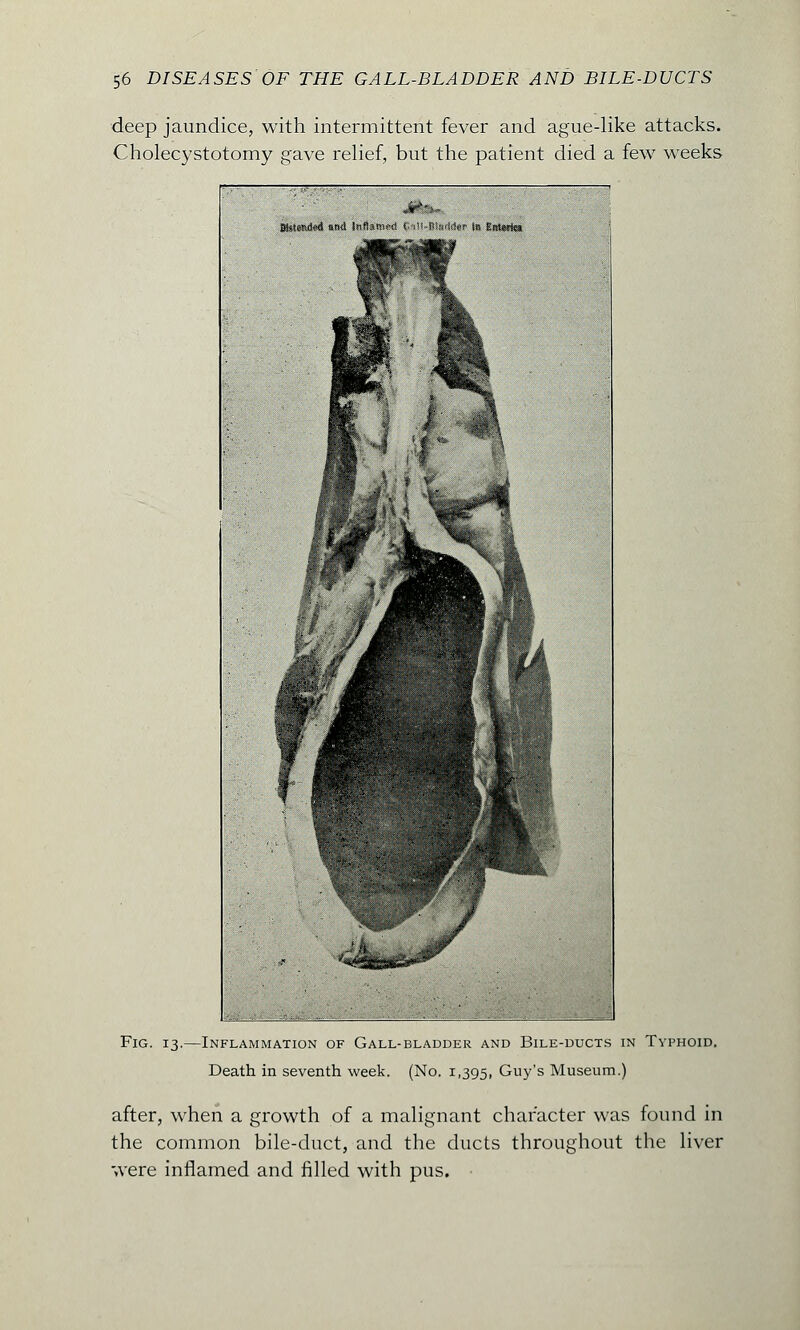 deep jaundice, with intermittent fever and ague-like attacks. Cholecystotomy gave relief, but the patient died a few weeks Fig. 13.—Inflammation of Gall-bladder and Bile-ducts in Typhoid. Death in seventh week. (No. 1,395, Guy's Museum.) after, when a growth of a malignant character was found in the common bile-duct, and the ducts throughout the liver were inflamed and filled with pus.