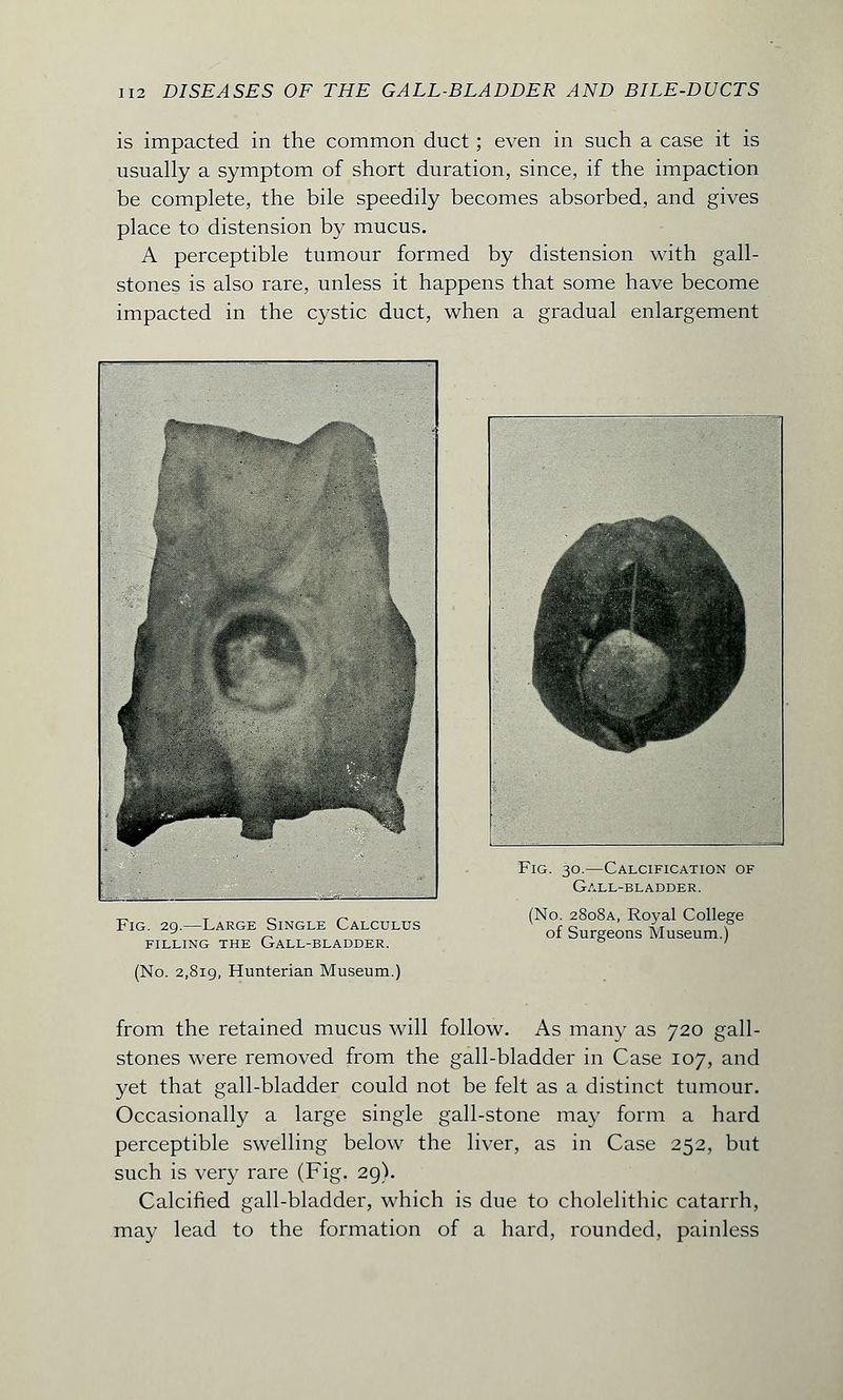 is impacted in the common duct; even in such a case it is usually a symptom of short duration, since, if the impaction be complete, the bile speedily becomes absorbed, and gives place to distension by mucus. A perceptible tumour formed by distension with gall- stones is also rare, unless it happens that some have become impacted in the cystic duct, when a gradual enlargement Fig. 29.—Large Single Calculus filling the gall-bladder. (No. 2,819, Hunterian Museum.) Fig. 30.—Calcification of Gall-bladder. (No. 2808A, Royal College of Surgeons Museum.) from the retained mucus will follow. As many as 720 gall- stones were removed from the gall-bladder in Case 107, and yet that gall-bladder could not be felt as a distinct tumour. Occasionally a large single gall-stone may form a hard perceptible swelling below the liver, as in Case 252, but such is very rare (Fig. 29). Calcified gall-bladder, which is due to cholelithic catarrh, may lead to the formation of a hard, rounded, painless