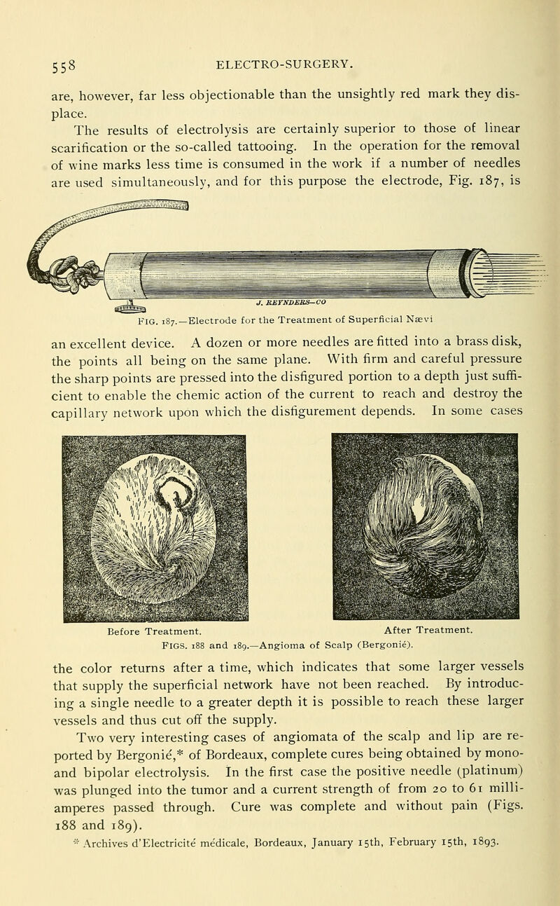 are, how^ever, far less objectionable than the unsightly red mark they dis- place. The results of electrolysis are certainly superior to those of linear scarification or the so-called tattooing. In the operation for the removal of wine marks less time is consumed in the work if a number of needles are used simultaneously, and for this purpose the electrode, Fig. 187, is Fig. 187. J. RMTNDERS-CO -Electrode for the Treatment of Superficial Naevi an excellent device. A dozen or more needles are fitted into a brass disk, the points all being on the same plane. With firm and careful pressure the sharp points are pressed into the disfigured portion to a depth just suffi- cient to enable the chemic action of the current to reach and destroy the capillary network upon which the disfigurement depends. In some cases Before Treatment. Figs. 188 After Treatment, and 189.—Angioma of Scalp (Bergonie). the color returns after a time, which indicates that some larger vessels that supply the superficial network have not been reached. By introduc- ing a single needle to a greater depth it is possible to reach these larger vessels and thus cut off the supply. Two very interesting cases of angiomata of the scalp and lip are re- ported by Bergonie',* of Bordeaux, complete cures being obtained by mono- and bipolar electrolysis. In the first case the positive needle (platinum) was plunged into the tumor and a current strength of from 20 to 61 milli- amperes passed through. Cure was complete and without pain (Figs. 188 and 189).  .\rchives d'Electricite medicale, Bordeaux, January 15th, February 15th, 1893.