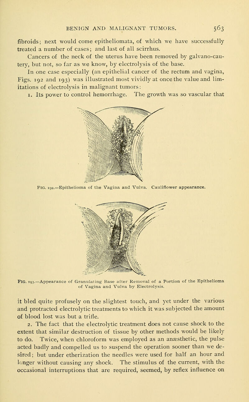 fibroids; next would come epitheliomata, of which we have successfully treated a number of cases; and last of all scirrhus. Cancers of the neck of the uterus have been removed by galvano-cau- tery, but not, so far as we know, by electrolysis of the base. In one case especially (an epithelial cancer of the rectum and vagina, Figs. 192 and 193) was illustrated most vividly at once the value and lim- itations of electrolysis in malignant tumors: I. Its power to control hemorrhage. The growth was so vascular that Fig. 192.—Epithelioma of the Vagina and Vulva. Cauliflower appearance. Fig. 193.—Appearance of Granulating Base after Removal of a Portion of the Epithelioma of Vagina and Vulva by Electrolysis. it bled quite profusely on the slightest touch, and yet under the various and protracted electrolytic treatments to which it was subjected the amount of blood lost was but a triile. 2. The fact that the electrolytic treatment does not cause shock to the extent that similar destruction of tissue by other methods would be likely to do. Twice, when chloroform was employed as an anaesthetic, the pulse acted badly and compelled us to suspend the operation sooner than we de- sired; but under etherization the needles were used for half an hour and longer without causing any shock. The stimulus of the current, with the occasional interruptions that are required, seemed, by reflex influence on