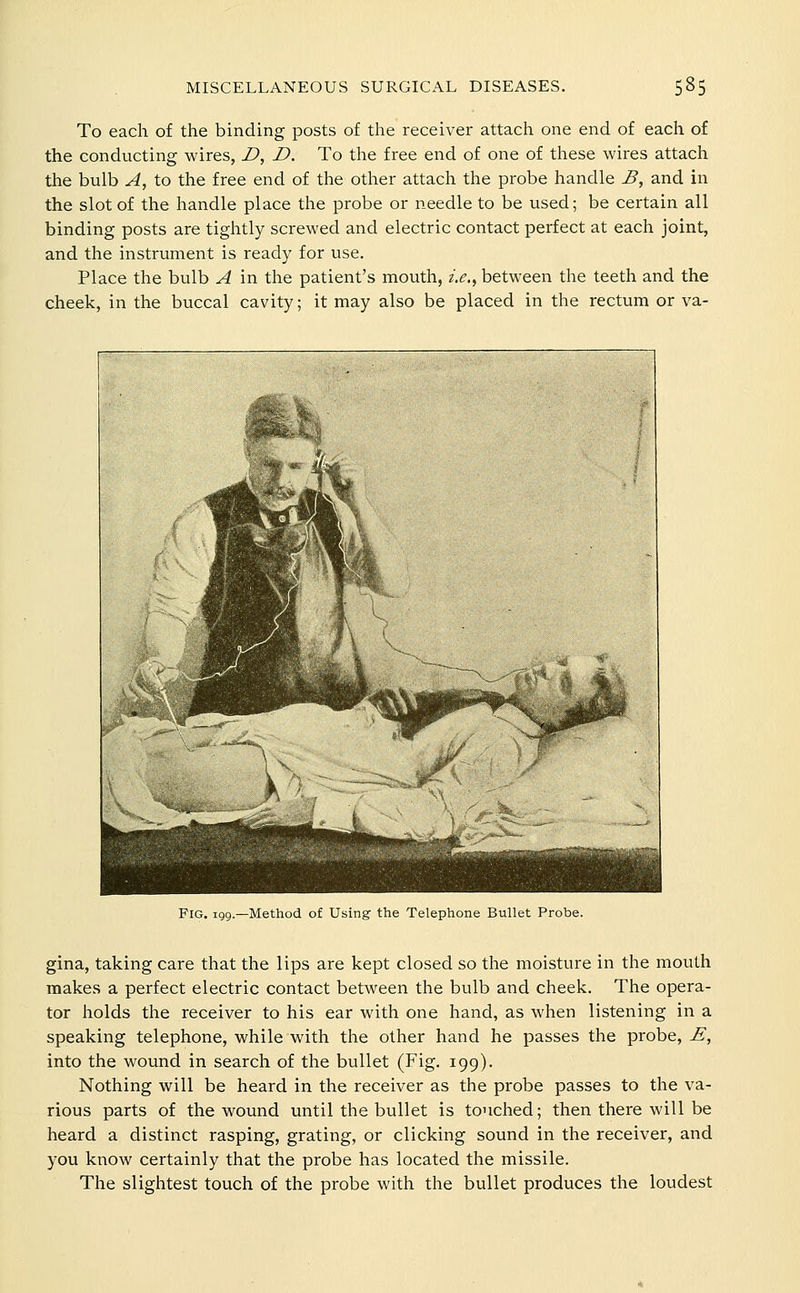 To each of the binding posts of the receiver attach one end of each of the conducting wires, D, D. To the free end of one of these wires attach the bulb A, to the free end of the other attach the probe handle B, and in the slot of the handle place the probe or needle to be used; be certain all binding posts are tightly screwed and electric contact perfect at each joint, and the instrument is ready for use. Place the bulb A in the patient's mouth, i.e.^ between the teeth and the cheek, in the buccal cavity; it may also be placed in the rectum or va- FiG. 199.—Method of Using the Telephone Bullet Probe. gina, taking care that the lips are kept closed so the moisture in the mouth makes a perfect electric contact between the bulb and cheek. The opera- tor holds the receiver to his ear with one hand, as when listening in a speaking telephone, while with the other hand he passes the probe, E, into the wound in search of the bullet (Fig. 199). Nothing will be heard in the receiver as the probe passes to the va- rious parts of the wound until the bullet is touched; then there will be heard a distinct rasping, grating, or clicking sound in the receiver, and you know certainly that the probe has located the missile. The slightest touch of the probe with the bullet produces the loudest