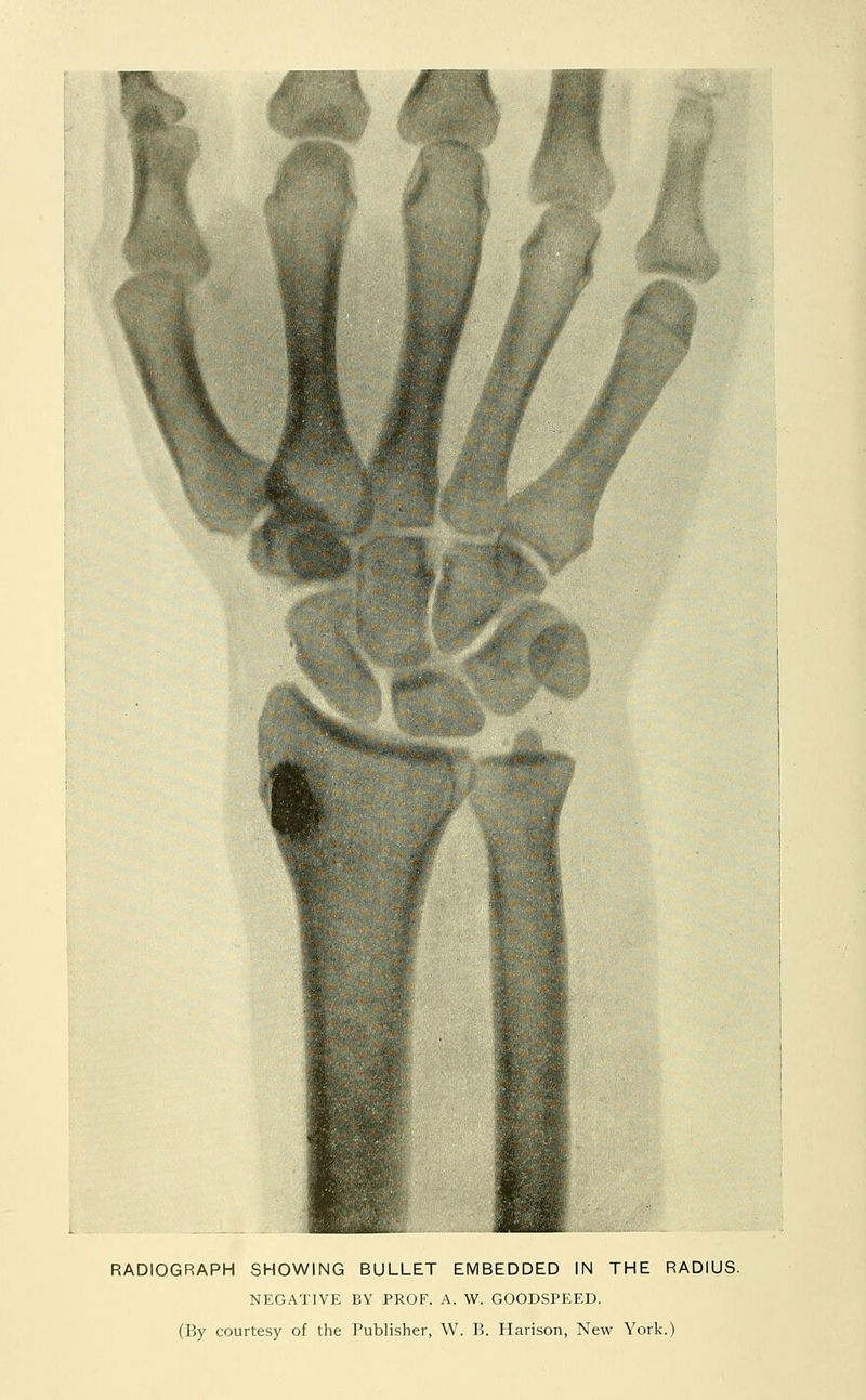 RADIOGRAPH SHOWING BULLET EMBEDDED IN THE RADIUS. NEGATIVE BY PROF. A. W. GOODSPEED. (By courtesy of the Publisher, W. B. Harison, New York.)