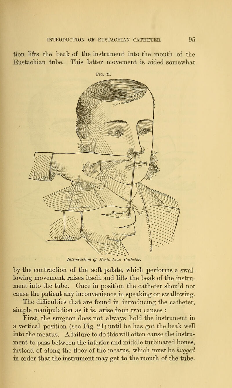 tion lifts the beak of the instrument into the mouth of the Eustachian tube. This latter movement is aided somewhat Introduction, of Eustachian Catheter. by the contraction of tlie soft palate, which performs a swal- lowing movement, raises itself, and lifts the beak of the instru- ment into the tube. Once in position the catheter should not cause the patient any inconvenience in speaking or swallowing. The difficulties that are found in introducing the catheter, simple manipulation as it is, arise from two causes : First, the surgeon does not always hold the instrument in a vertical position (see Fig. 21) until he has got the beak well into the meatus. A failure to do this will often cause the instru- ment to pass between the inferior and middle turbinated bones, instead of along the floor of the meatus, which must be hugged in order that the instrument may get to the mouth of the tube.