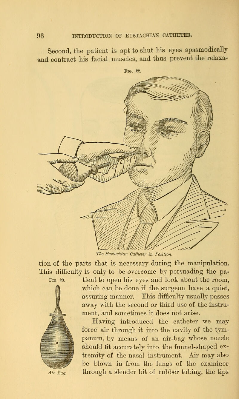 Second, the patient is apt to shut his eyes spasmodically and contract his facial muscles, and thus prevent the relaxa- The Eustachian Catheter in Position. tion of the parts that is necessary during the manipulation. This difficulty is only to be overcome by persuading the pa- fig. 23. tient to open his eyes and look about the room, which can be done if the surgeon have a quiet, assuring manner. This difficulty usually passes away with the second or third use of the instru- ment, and sometimes it does not arise. Having introduced the catheter we may force air through it into the cavity of the tym- panum, by means of an air-bag whose nozzle should fit accurately into the funnel-shaped ex- tremity of the nasal instrument. Air may also be blown in from the lungs of the examiner through a slender bit of rubber tubing, the tips