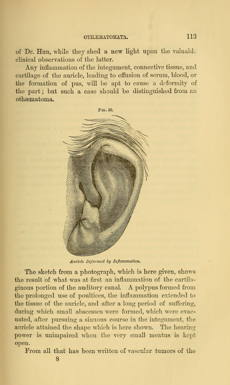 of Dr. Hun, while they shed a new light upon the valuable clinical observations of the latter. Any inflammation of the integument, connective tissue, and cartilage of the auricle, leading to effusion of serum, blood, or the formation of pus, will be apt to cause a deformity of the part; but such a case should be distinguished from an othematoma. Auricle Deformed by Inflammation, The sketch from a photograph, which is here given, shows the result of what was at first an inflammation of the cartila- ginous portion of the auditory canal. A polypus formed from the prolonged use of poultices, the inflammation extended to the tissue of the auricle, and after a long period of suffering, during which small abscesses were formed, which were evac- uated, after pursuing a sinuous course in the integument, the auricle attained the shape which is here shown. The hearing power is unimpaired when the very small meatus is kept open. From all that has been written of vascular tumors of the 8