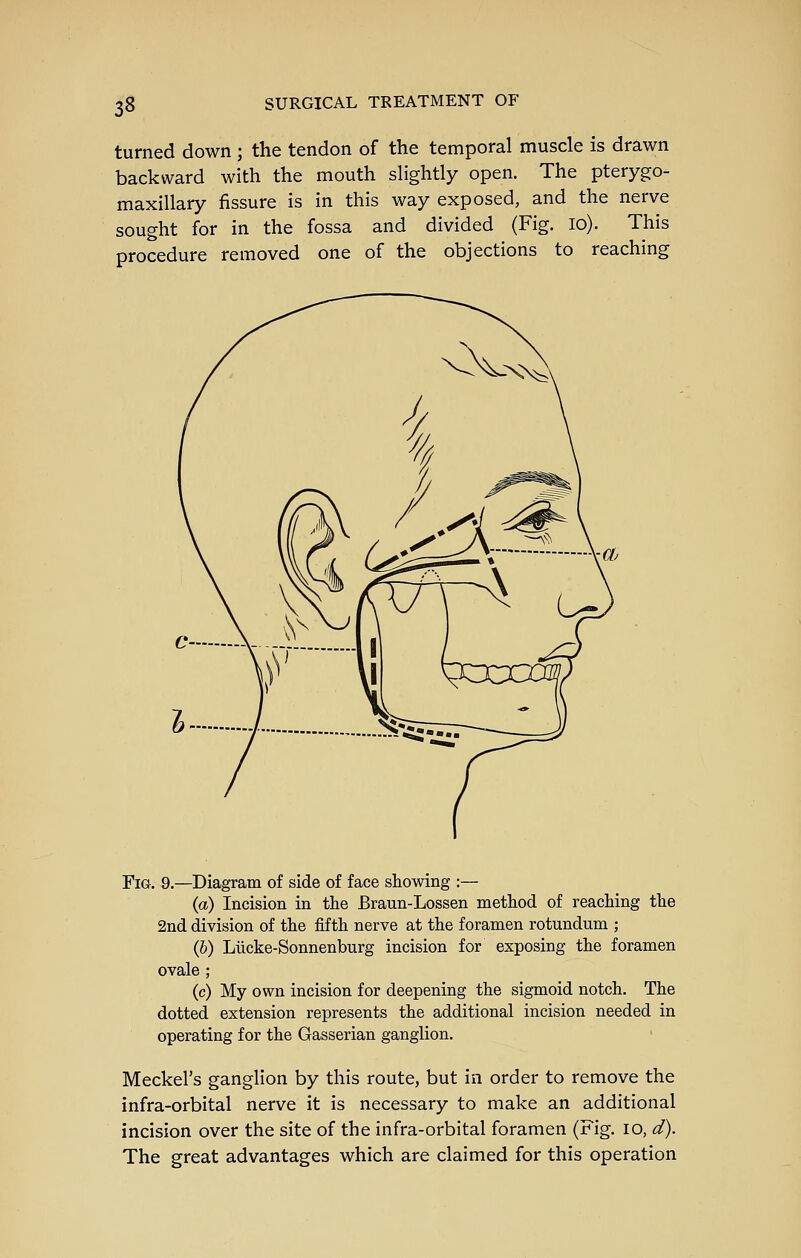 turned down ; the tendon of the temporal muscle is drawn backward with the mouth slightly open. The pterygo- maxillary fissure is in this way exposed, and the nerve sought for in the fossa and divided (Fig. lo). This procedure removed one of the objections to reaching Fig. Q.—Diagram of side of face showing :— (a) Incision in the Braun-Lossen method of reaching the 2nd division of the fifth nerve at the foramen rotundum ; (b) Liicke-Sonnenburg incision for exposing the foramen ovale ; (c) My own incision for deepening the sigmoid notch. The dotted extension represents the additional incision needed in operating for the Gasserian ganglion, Meckel's ganglion by this route, but in order to remove the infra-orbital nerve it is necessary to make an additional incision over the site of the infra-orbital foramen (Fig. lo, d). The great advantages which are claimed for this operation