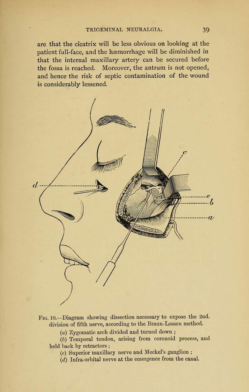 are that the cicatrix will be less obvious on looking at the patient full-face, and the haemorrhage will be diminished in that the internal maxillary artery can be secured before the fossa is reached. Moreover, the antrum is not opened, and hence the risk of septic contamination of the wound is considerably lessened. Fig. 10.—Diagram showing dissection necessary to expose the 2nd. division of fifth nerve, according to the Braun-Lossen method. (a) Zygomatic arch divided and turned down ; (6) Temporal tendon, arising from coronoid process, and held back by retractors ; (c) Superior maxillary nerve and Meckel's ganglion ; (d) Infra-orbital nerve at the emergence from the canal.